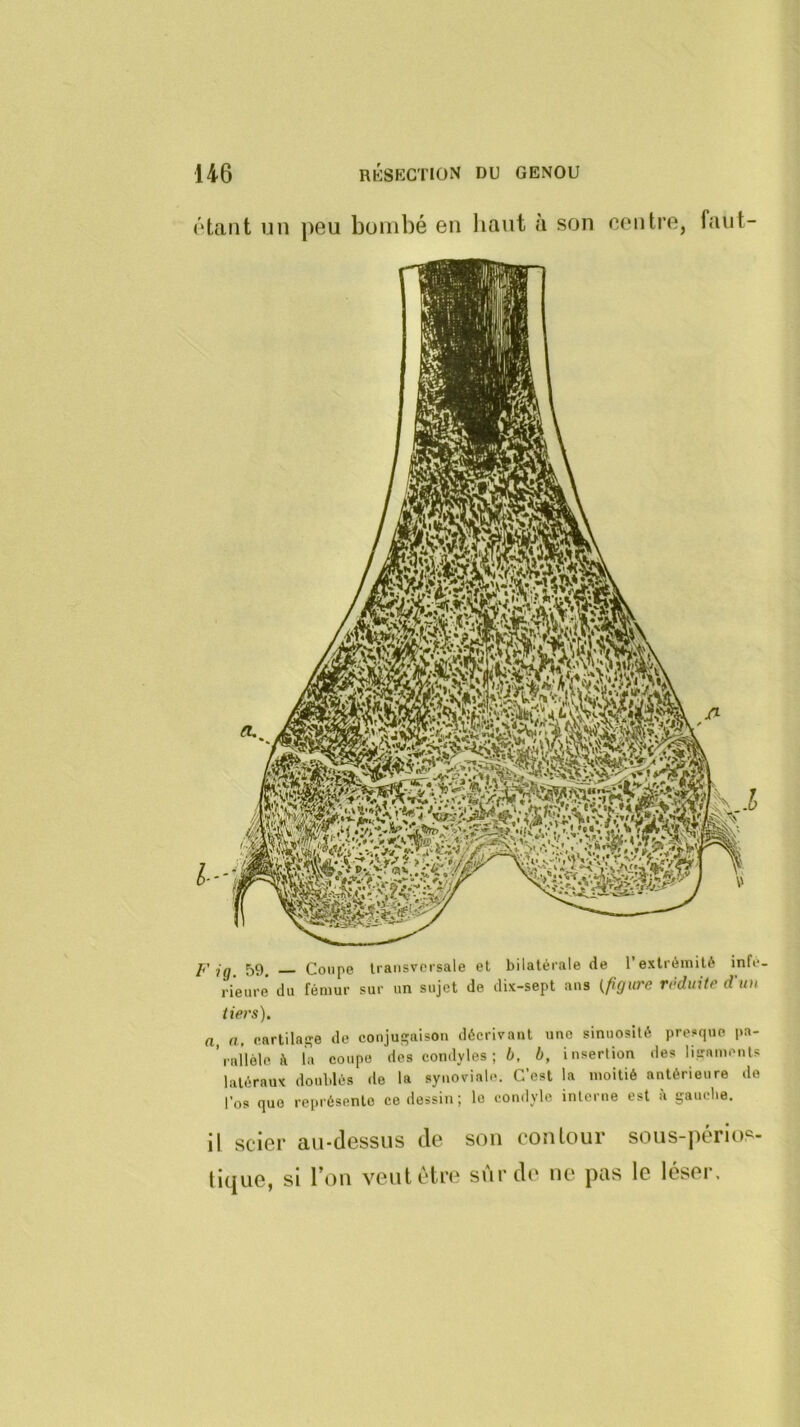 étant un peu bombé en liant a son centre, faut- F ig. 59. Coupe transversale et bilatérale de l’extrémité infé- rieure du fémur sur un sujet de dix-sept ans {figure réduite d'un tiers). a, a, eartilase de conjusaisoii décrivant une sinuosité presque pa- ’rallèle à la coupe des condyles ; 6, b, insertion des lisamouts latéraux doublés de la synoviale. C’est la moitié antérieure de l’os quo représente ce dessin ; le comlyle interne est à gauebe. il scier au-dessus de son contour sous-périos- tique, si l’on veutèti’(‘ sur de ne pas le léser.