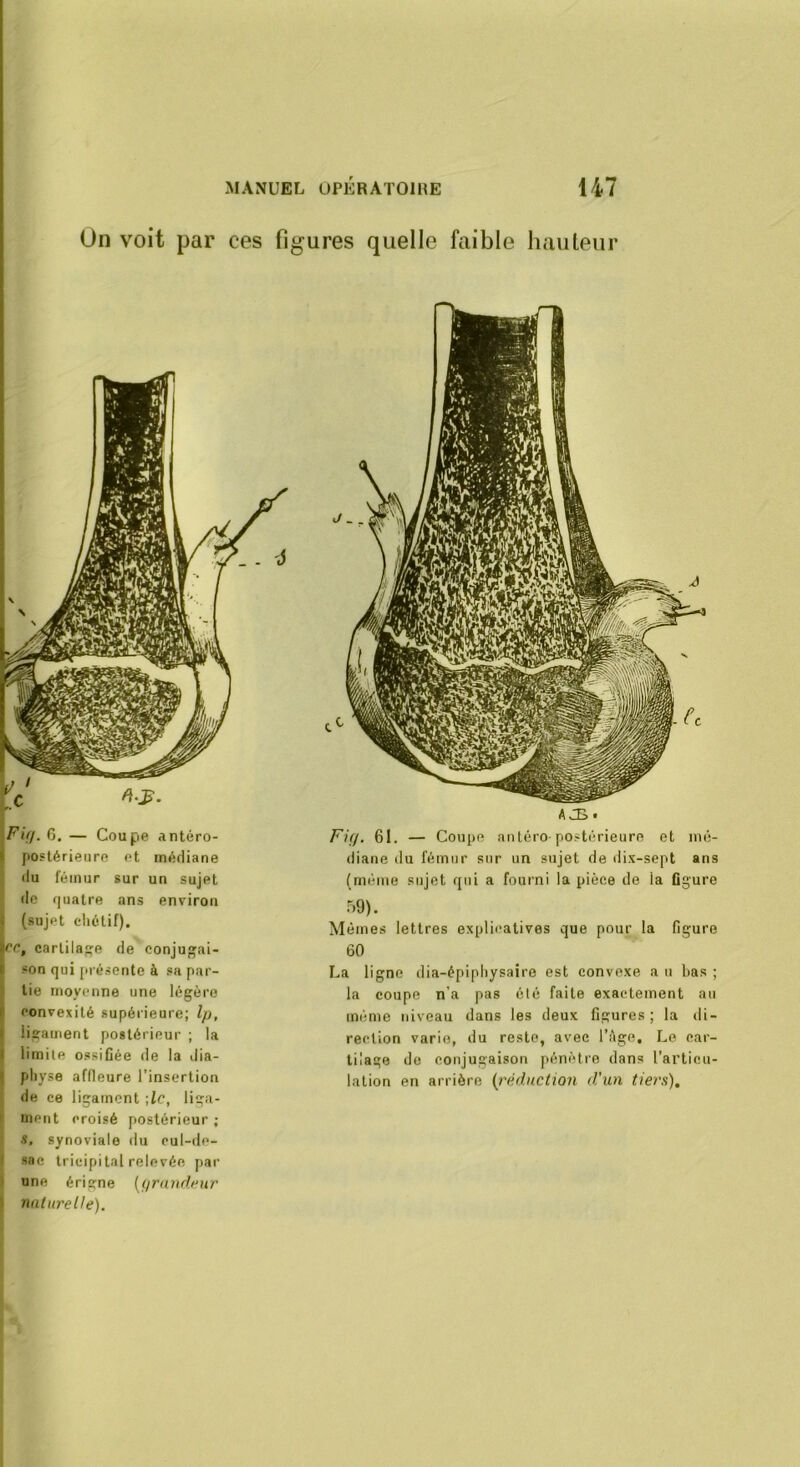 Un voit par ces figures quelle faible hauteur Fi(l. 6, — Coupe antéro- postérieiiro et médiane tiu fémur sur un sujet do (juatre ans environ (sujet chétif). ce, cartilage de conjugai- son qui présente à sa par- tie moyenne une légère convexité supérieure; Ip, ligament postérieur ; la limite ossifiée de la dia- physe affleure l’insertion de ce ligament \lc, liga- ment croisé postérieur ; S, synoviale du cul-de- sac tricipi tal relevée par une ériçne {prauflcnr nnluretle). AJB. Fifi. 61. — Coupe anléro-postérieure et mé- diane du fémur sur un sujet de dix-sept ans (même sujet qui a fourni la pièce de la Ggure 59). Mêmes lettres explicatives que pour la figure 60 La ligne dia-épipliysaire est convexe a n bas ; la coupe n’a pas clé faite exactement au même niveau dans les deux ligures; la ili- reclion varie, du reste, avec l’Age, Le car- tilage de conjugaison pénètre dans l’articu- lation en arrière {j'éduclion d'un tiers).