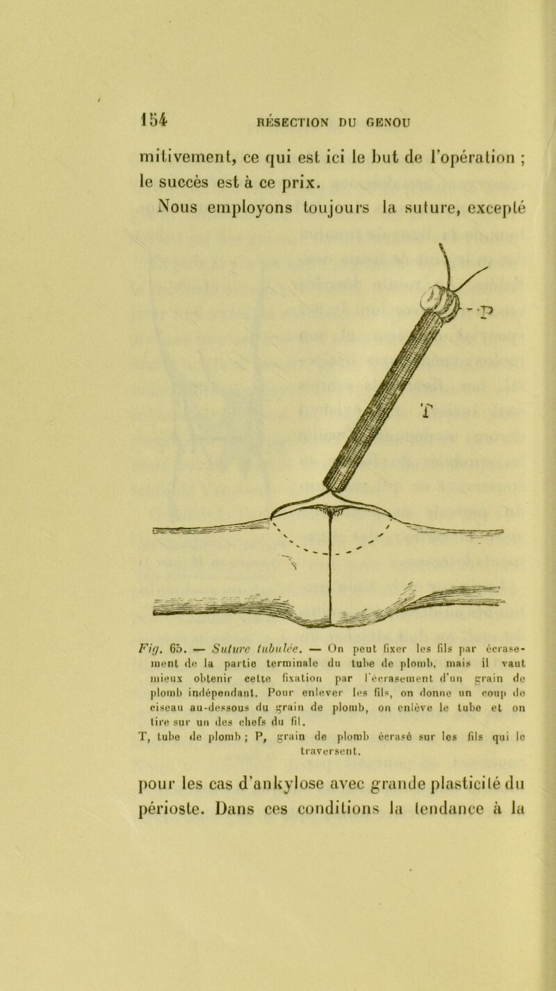 mitivement, ce qui est ici le but de l’opération ; le succès est à ce prix. Nous employons toujours la suture, excepté Fig. 65. — Suture tubulée. — On peut fixer les fils par écrase- ment (le la partie terminale du tube de plomb, mais il vaut mieux obtenir cette fixation par l'écrasement d’un grain de plomb indépendant. Pour enlever les fils, on donne un coui) do ciseau au-dessous du grain de plomb, on enlève le tube et on lire sur un des chefs du fil. T, tube de plomb ; P, grain de plomb écrasé sur les fils qui lo traversent. j)our les cas d’ankylose avec grande plasticité du périoste. Dans ces conditions la tendance à la