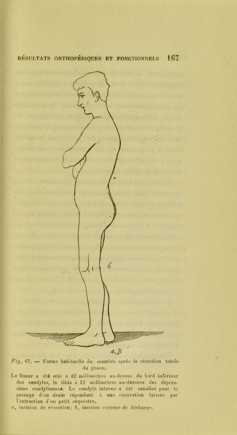 Fi(j. 67. •— Forme liabiluclle ilu membre après la résection totale (lu genou. Le fémur a été scié à 42 niilliiiwHres au-dessus du bord infc'Tieur des condyles, le tibia à 12 millini(*tres au-dessous des dépres- sions condyliennes. I.e condylc interne a été canalisé pour le passage d’un drain répondant à une excavation laissée par l’extraction d'un petit sé((uestre. <1, incision de n'-sncfion ; />, incision externe de décharge.