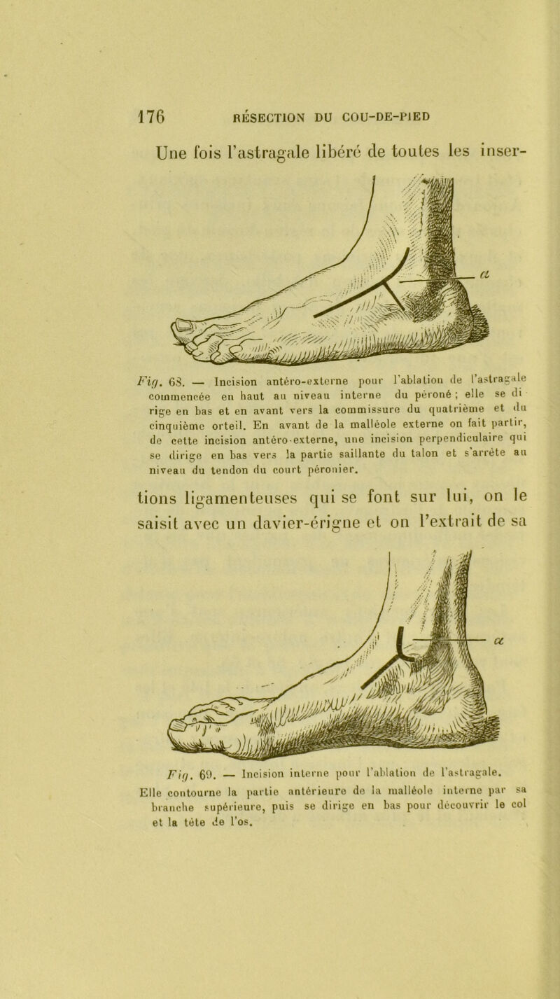 Une fois l’astrcigHle libéré de toutes les inser- Fiff. 6S. — Incision antéro-extcrne pour l’ablaliou de l’astragale commencée en haut au niveau interne du péroné ; elle se di rige en bas et en avant vers la commissure du quatrième et du cinquième orteil. En avant de la malléole externe on fait partir, de cette incision antéro externe, une incision perpendiculaire qui se dirige en bas vers la partie saillante du talon et s arrête au niveau du tendon du court péronier. lions ligamenteuses qui se font sur lui, on le saisit avec un davier-érigne et on l’extrait de sa F'iff. 60. Incision interne pour l’ablation de l’astragale. Elle contourne la partie antérieure de la malléole interne par sa branche supérieure, puis se dirige en bas pour découvrir le col et la tête de l’os.