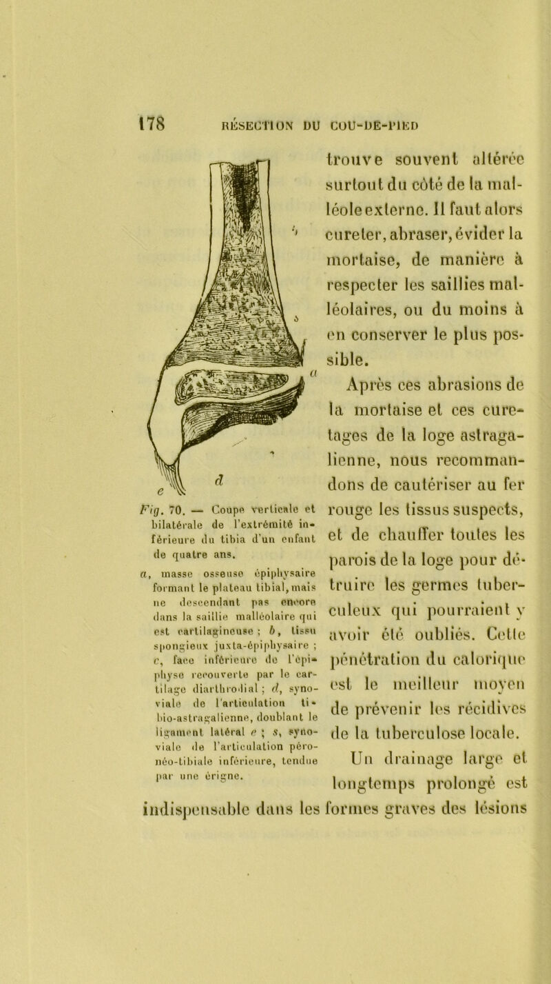 Fig. 70, — Coupe vBrlicnlc et bilatérale de l’exlrétuité in- férieure du tibia d’un enfant de quatre ans. n, masse osseuse épipliysaire formant le plateau tibial,mais ne descendant pas encore dans la saillie malléolaire qui est cartilagineuse; b, tissu spongieux juxta-épipliysaire ; c, face inférieure de l’épi- pliysc recouverte par le car- tilage diarthrodial ; d, syno- viale de l’articulation ti* bio-astragalienne, doublant le ligament latéral e ; s, syno- viale de l’articulation péro- néo-tibiale inférieure, tendue par urm érigne. iiKlisjJOiisablc dans les trouve souvent altérée surtout du côté de la mal- léole externe. 11 faut alors cureter, abraser, évider la mortaise, de manière à respecter les saillies mal- léolaires, ou du moins à en conserver le plus pos- sible. Ap rès ces abrasions de la mortaise et ces cure* tages de la loge aslraga- lienne, nous recomman- dons de cautériser au fer rouge les tissus suspects, et de chauffer toutes les parois de la loge pour dé- truire les germes ttiber- culeux qui pourraient y avoir été oubliés. Ci'tle pénétration du caloriqtie est le meillenr moyen de prévenir les récidives de la tuberculose locale. Un drainage large et longtemps prolongé est formes graves des lésions