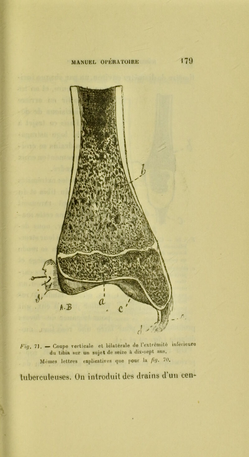 Fifj, 71, — Coupe verticale et bilatérale de 1 extrémité iiiféiieure du tibia sur un sujet de seize à dix-sept ans. Mêmes lettres explicatives ijiie pour la fifi. 70. tuberculeuses. On introduit des drains d un cen-