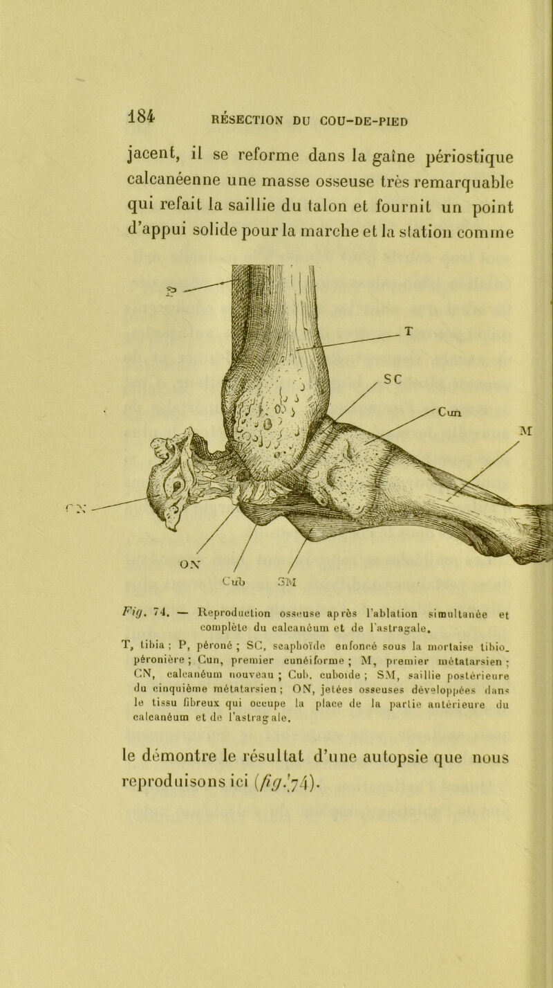 jacent, il se reforme dans la gaine périostique calcanéenne une masse osseuse très remarquable qui refait la saillie du talon et fournit un point d appui solide pour la marche et la slatîon comme ox C lib Sl'I Cun Ftfj. 74. — Reproduelion osseuse après l’ablation simultanée et complète du calcanéum et de l’astragale. T, tibia; P, péroné; SC, scaphoïde enfoncé sous la mortaise libio. péronière ; Cun, premier cunéiforme ; M, premier métatarsien ; CN, calcanéum nouveau ; Cuh. cuboïde ; SM, saillie postérieure du cinquième métatarsien ; ON, jetées osseuses développées dans le tissu fibreux qui occupe la place de la partie antérieure du calcanéum et île l’astragale. le démontre le résultat d’une autopsie que nous reproduisons ici