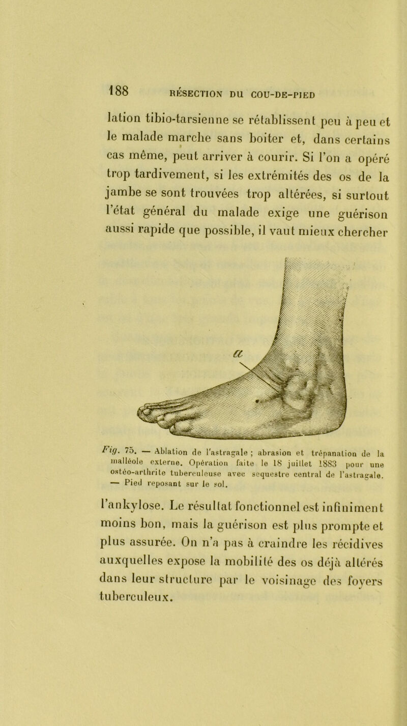 lation tibio-tarsienne se rétablissent peu à peu et le malade marcbe sans boiter et, dans certains cas même, peut arriver à courir. Si l’on a opéré trop tardivement, si les extrémités des os de la jambe se sont trouvées trop altérées, si surtout l’état général du malade exige une guérison aussi rapide que possible, il vaut mieux cbercber Fig. 75. — Ablation de l'astragale ; abrasion et trépanation de la nialléole externe. Opération faite le 18 juillet 1883 pour une ostéo-arthrite tuberouleuse avec séquestre central de l’astraçale. — Pied reposant sur le sol. 1 ankylosé. Le résultat fonctionnel est infiniment moins bon, mais la guérison est plus prompte et plus assurée. On na pas à craindre les récidives auxquelles expose la mobilité des os déjà altérés dans leur structure par le voisinage des foyers tuberculeux.