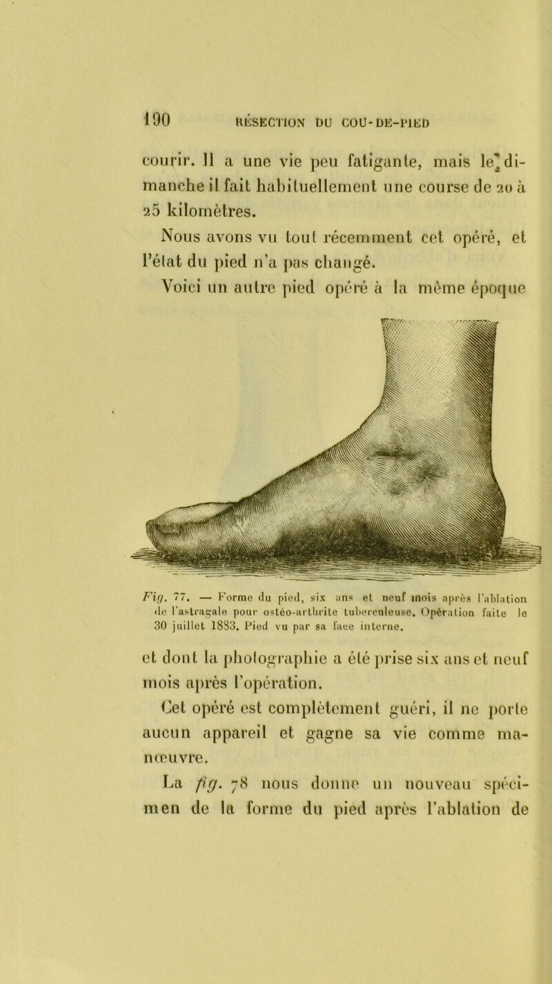 courir. Il a une vie peu fatigante, mais le^di- manche il fait habituellement une course de 20 à 25 kilomètres. Nous avons vu tout récemment cet opéré, et l’état du pied n'a pas changé. Voici un autre pied opéré à la même époque Fia. 77. — Forme du pied, sis ans et neuf mois après l’ablation de l’astraçale pour ostéo-arlhrite tuberculeuse. Opération faite le 30 juillet 1883. Pied vu par sa face interne. et dont la jiholographie a été prise six ans et neuf mois après l’opération. Cet opéré est complètement guéri, il ne porte aucun appareil et gagne sa vie comme ma- nœuvre. La pg. 78 nous donne un nouveau spéci- men de la forme du pied après l’ablation de