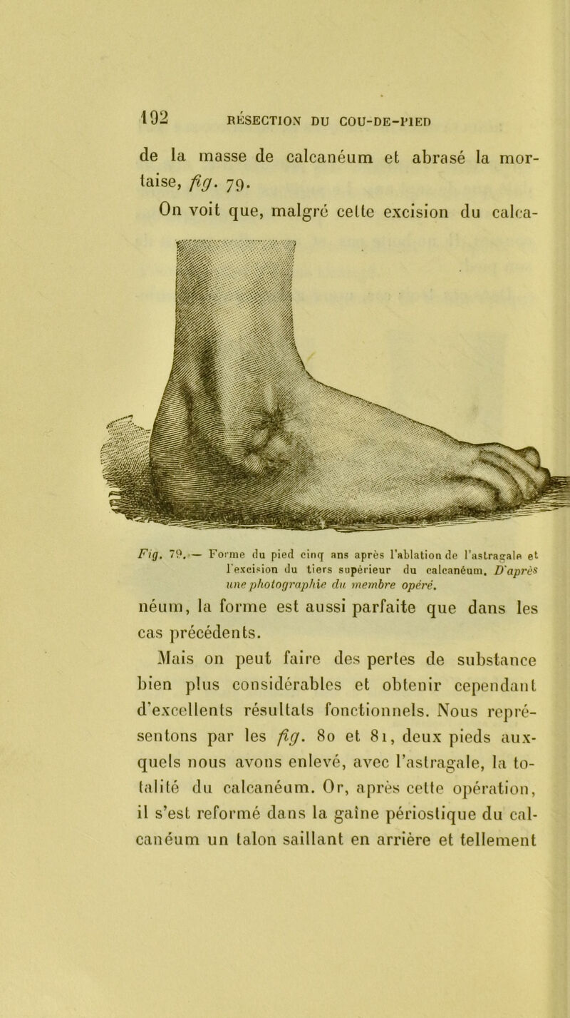 de la masse de calcanéum et abrasé la mor- taise, flg. 79. On voit que, malgré celle excision du calca- Fig. 79.•— Forme du pied cinq ans après l’ablation de l’astragale et l'excision du tiers supérieur du calcanéum. D'après une photographie du membre opéré, néum, la forme est aussi parfaite que dans les cas précédents. Mais on peut faire des pertes de substance bien plus considérables et obtenir cependant d’excellents résultats fonctionnels. Nous repré- sentons par les flg. 80 et 81, deux pieds aux- quels nous avons enlevé, avec l’astragale, la to- talité du calcanéum. Or, après cette opération, il s’est reformé dans la gaine périoslique du cal- canéum un talon saillant en arrière et tellement