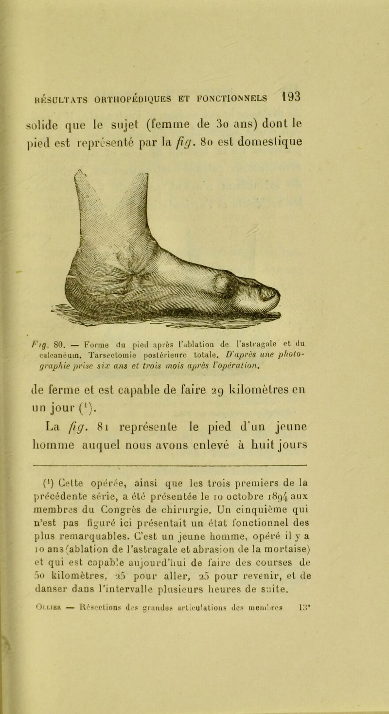solide que le sujet (femme de 3o ans) dont le j)ied est leprésenté par la fg. 8o est domestique Fig. 80. — Forme du pied après l’ablalion de l’astragale et du caleanéuin. Tarsectomie postérienro totale. D'après une photo- graphie prise six ans et trois mois api'ès l'opération. de ferme et est capable de faire yq) kilomètres en un jour (*). La pg. 8i représente le pied d'un jeune homme auquel nous avons enlevé à huit jours (’) Celte opéf»!“e, ainsi que les trois premiers de la précédente série, a été présentée le lo octobre i<Sg4 aii.x: membres du Congrès de chirurgie. Un cinquième qui n’est pas figuré ici présentait un état lonctionnel des plus remarquables. C’est un jeune homme, opéré il y a 10 ans (ablation de l’astragale et abrasion de la mortaise) et qui est capable aujourd’hui de faire des courses de ')() kilomètres, pour aller, aô pour revenir, et de danser dans l’intervalle plusieurs heures de suite. Oi.LiKn — Uèsoclions di's grandes luTii'uUtions des memlii’cs llî*