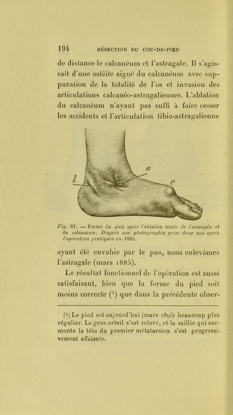 (le dislance le calcaiicjum et l’astragale. Il s’agis- sait d’une ostéite aiguë du calcanéum avec sup- puration de la totalité de l’os et invasion des articulations calcanéo-astragaliennes. L’ablation du calcanéum n’ayant pas suffi à faire cesser les accidents et l’articulation tibio-astragaiienne Fi(]. S). — F'orme lîu i)ied après Fahlalion lolalo da raslro2;alo cl du l•alcalléuln. Tt'aprî'ü une photOfira^ihic prise deux (vis oprrs l'opération pratiquée en IS85. ayant été envahie par le ]uis, nous enlevâmes l’astragale (mars i885). Le résultat fonctionnel de l’opération est aussi satisfaisant, bien fpie la forme du pied soit moins correcte (^) que dans la précédente obser- (J)Le pied est aujourd’hui (mars i8f)5) beaucoup plus régulier. Le gros orteil s’est relevé, et la saillie qui sur- monte la tête du premier métatarsien s’est progressi- vement afîaissée.