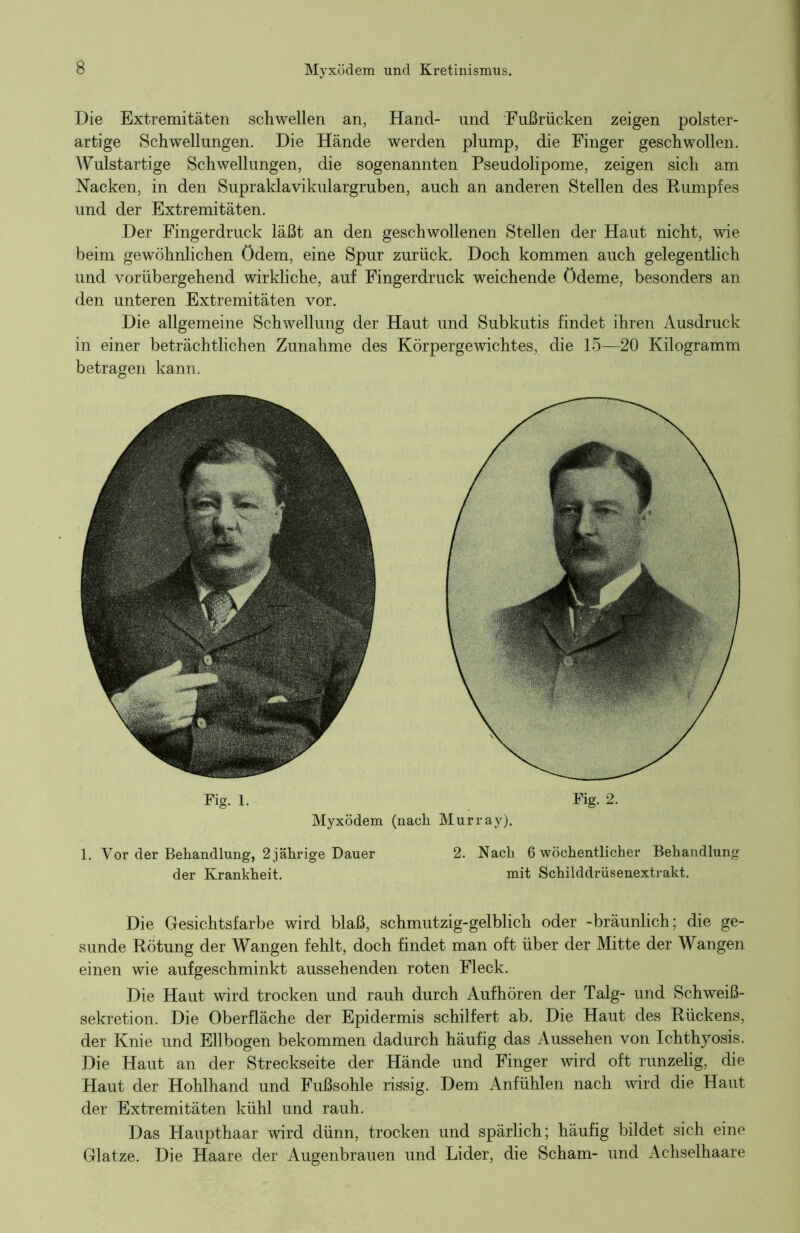 Die Extremitäten schwellen an, Hand- und Fußrücken zeigen polster- artige Schwellungen. Die Hände werden plump, die Finger geschwollen. Wulstartige Schwellungen, die sogenannten Pseudolipome, zeigen sich am Nacken, in den Supraklavikulargruben, auch an anderen Stellen des Rumpfes und der Extremitäten. Der Fingerdruck läßt an den geschwollenen Stellen der Haut nicht, wie beim gewöhnlichen ödem, eine Spur zurück. Doch kommen auch gelegentlich und vorübergehend wirkliche, auf Fingerdruck weichende Ödeme, besonders an den unteren Extremitäten vor. Die allgemeine Schwellung der Haut und Subkutis findet ihren Ausdruck in einer beträchtlichen Zunahme des Körpergewichtes, die 15—20 Kilogramm betragen kann. Fig. 1. Fig. 2. Myxödem (nach Murray). 1. Vor der Behandlung, 2 jährige Dauer 2. Nach 6 wöchentlicher Behandlung der Krankheit. mit Schilddrüsenextrakt. Die Gesichtsfarbe wird blaß, schmutzig-gelblich oder -bräunlich; die ge- sunde Rötung der Wangen fehlt, doch findet man oft über der Mitte der Wangen einen wie aufgeschminkt aussehenden roten Fleck. Die Haut wird trocken und rauh durch Aufhören der Talg- und Schweiß- sekretion. Die Oberfläche der Epidermis schilfert ab. Die Haut des Rückens, der Knie und Ellbogen bekommen dadurch häufig das Aussehen von Ichthyosis. Die Haut an der Streckseite der Hände und Finger wird oft runzelig, die Haut der Hohlhand und Fußsohle rissig. Dem Anfühlen nach wird die Haut der Extremitäten kühl und rauh. Das Haupthaar wird dünn, trocken und spärlich; häufig bildet sich eine Glatze. Die Haare der Augenbrauen und Lider, die Scham- und Achselhaare