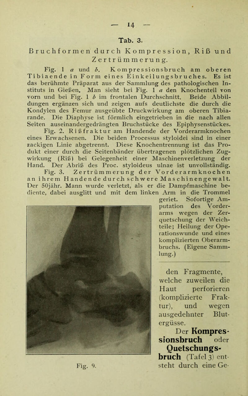 Tab. 3. Bruchformen durch Kompression, Riß und Zertrümmerung. Fig. 1 a und b. Kompressionsbruch am oberen Tibiaende in Form eines Einkeilungsbruches. Es ist das berühmte Präparat aus der Sammlung des pathologischen In- stituts in Gießen. Man sieht bei Fig. 1 a den Knochenteil von vorn und bei Fig. 1 i im frontalen Durchschnitt. Beide Abbil- dungen ergänzen sich und zeigen aufs deutlichste die durch die Kondylen des Femur ausgeübte Druckwirkung am oberen Tibia- rande. Die Diaphyse ist förmlich eingetrieben in die nach allen Seiten auseinandergedrängten Bruchstücke des Epiphysenstückes. Fig. 2. Rißfraktur am Handende der Vorderarmknochen eines Erwachsenen. Die beiden Processus styloidei sind in einer zackigen Linie abgetrennt. Diese Knochentrennung ist das Pro- dukt einer durch die Seitenbänder übertragenen plötzlichen Zug- wirkung (Riß) bei Gelegenheit einer Maschinenverletzung der Hand. Der Abriß des Proc. styloideus ulnae ist unvollständig. Fig. 3. Zertrümmerung der Vorderarmknochen an ihrem Handende durcä schwere Maschinengewalt. Der 50jähr. Mann wurde verletzt, als er die Dampfmaschine be- diente, dabei ausglitt und mit dem linken Arm in die Trommel geriet. Sofortige Am- putation des Vorder- arms wegen der Zer- quetschung der Weich- teile; Heilung der Ope- rationswunde und eines komplizierten Oberarm- bruchs. (Eigene Samm- lung.) den Fragmente, welche zuweilen die Haut perforieren (komplizierte Frak- tur), und wegen ausgedehnter Blut- ergüsse. Der Kompres- sionsbruch oder Quetschungs- bruch (Tafel 3) ent- steht durch eine Gc- Fig. 9.