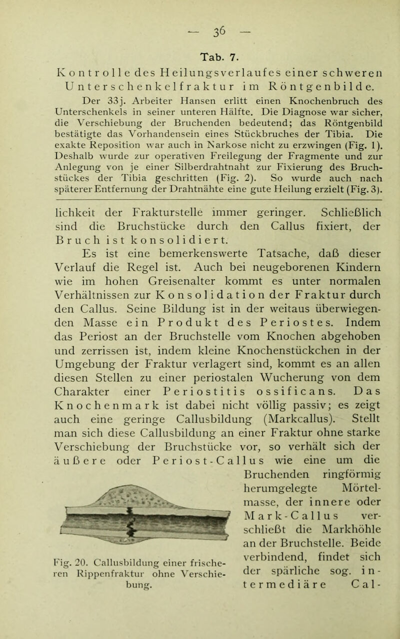 Tab. 7. Kontrolle des Heilungsverlaufes einer schweren Unterschenkelfraktur im Röntgenbilde. Der 33j. Arbeiter Hansen erlitt einen Knochenbruch des Unterschenkels in seiner unteren Hälfte. Die Diagnose war sicher, die Verschiebung der Bruchenden bedeutend; das Röntgenbild bestätigte das Vorhandensein eines Stückbruches der Tibia. Die exakte Reposition war auch in Narkose nicht zu erzwingen (Fig. 1). Deshalb wurde zur operativen Freilegung der Fragmente und zur Anlegung von je einer Silberdrahtnaht zur Fixierung des Bruch- stückes der Tibia geschritten (Fig. 2). So wurde auch nach späterer Entfernung der Drahtnähte eine gute Heilung erzielt (Fig. 3). lichkeit der Frakturstelle immer geringer. Schließlich sind die Bruchstücke durch den Callus fixiert, der Bruch ist konsolidiert. Es ist eine bemerkenswerte Tatsache, daß dieser Verlauf die Regel ist. Auch bei neugeborenen Kindern wie im hohen Greisenalter kommt es unter normalen Verhältnissen zur Konsolidation der Fraktur durch den Callus. Seine Bildung ist in der weitaus überwiegen- den Masse ein Produkt des Periostes. Indem das Periost an der Bruchstelle vom Knochen abgehoben und zerrissen ist, indem kleine Knochenstückchen in der Umgebung der Fraktur verlagert sind, kommt es an allen diesen Stellen zu einer periostalen Wucherung von dem Charakter einer Periostitis ossificans. Das Knochenmark ist dabei nicht völlig passiv; es zeigt auch eine geringe Callusbildung (Markcallus). Stellt man sich diese Callusbildung an einer Fraktur ohne starke Verschiebung der Bruchstücke vor, so verhält sich der äußere oder Periost-Callus wie eine um die Bruchenden ringförmig herumgelegte Mörtel- masse, der innere oder Mark- Callus ver- schließt die Markhöhle an der Bruchstelle. Beide verbindend, findet sich der spärliche sog. i n - termediäre Cal- Fig. 20. Callusbildung einer frische- ren Rippenfraktur ohne Verschie- bung.