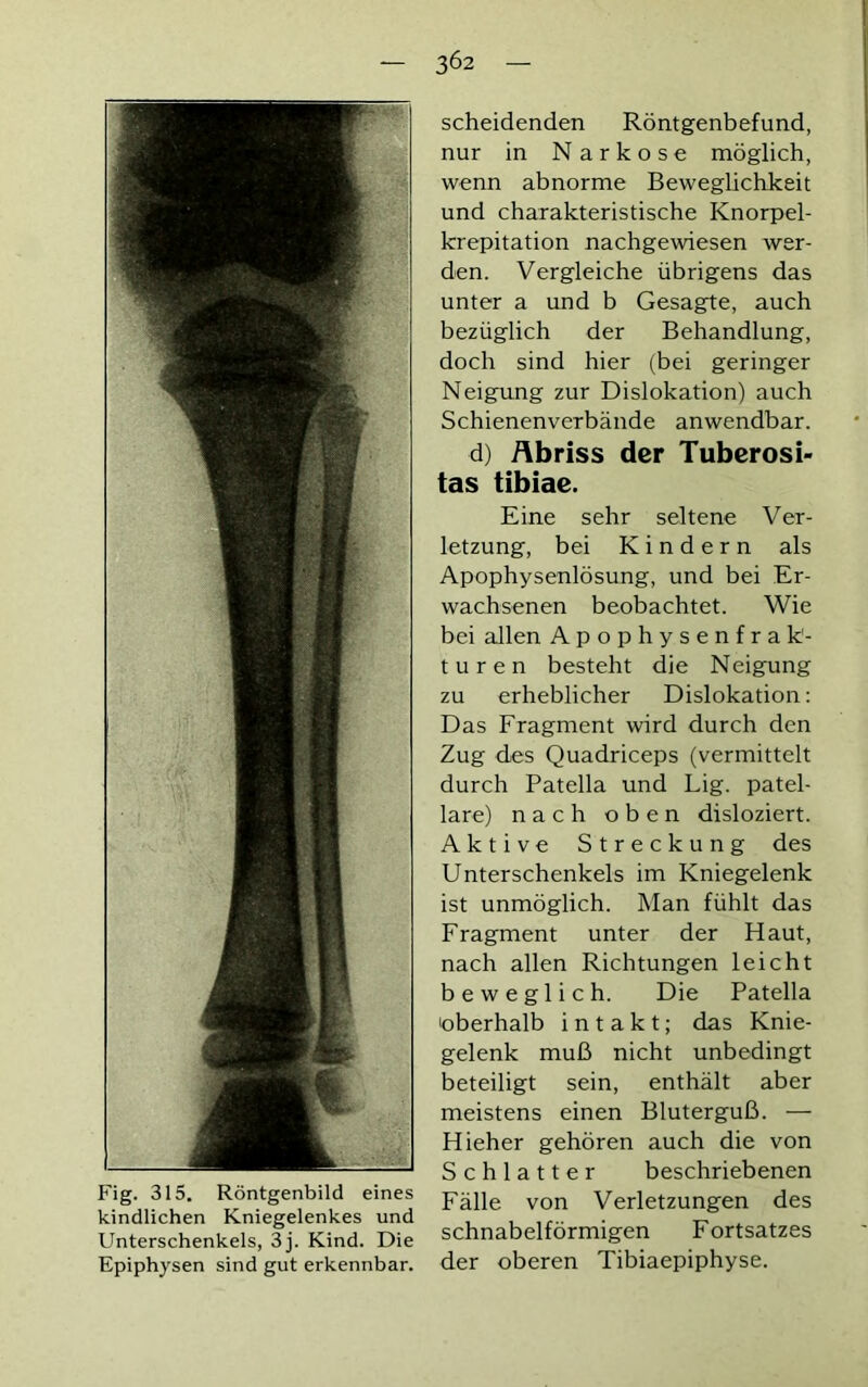 Fig. 315. Röntgenbild eines kindlichen Kniegelenkes und Unterschenkels, 3j. Kind. Die Epiphysen sind gut erkennbar. scheidenden Röntgenbefund, nur in Narkose möglich, wenn abnorme Beweglichkeit und charakteristische Knorpel- krepitation nachgewiesen wer- den. Vergleiche übrigens das unter a und b Gesagte, auch bezüglich der Behandlung, doch sind hier (bei geringer Neigung zur Dislokation) auch Schienenverbände anwendbar. d) Abriss der Tuberosi- tas tibiae. Eine sehr seltene Ver- letzung, bei Kindern als Apophysenlösung, und bei Er- wachsenen beobachtet. Wie bei allen Apophysenfrak- turen besteht die Neigung zu erheblicher Dislokation: Das Fragment wird durch den Zug des Quadriceps (vermittelt durch Patella und Lig. patel- lare) nach oben disloziert. Aktive Streckung des Unterschenkels im Kniegelenk ist unmöglich. Man fühlt das Fragment unter der Haut, nach allen Richtungen leicht beweglich. Die Patella oberhalb intakt; das Knie- gelenk muß nicht unbedingt beteiligt sein, enthält aber meistens einen Bluterguß. — Hieher gehören auch die von Schiatter beschriebenen Fälle von Verletzungen des schnabelförmigen Fortsatzes der oberen Tibiaepiphyse.