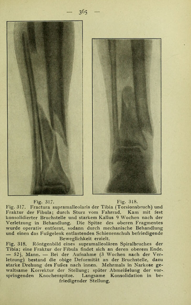 Fig. 317- Fig. 318. Fig. 317. Fractura supramalleolaris der Tibia (Torsionsbruch) und Fraktur der Fibula; durch Sturz vom Fahrrad. Kam mit fest konsolidierter Bruchstelle und starkem Kallus 9 Wochen nach der Verletzung in Behandlung. Die Spitze des oberen Fragmentes wurde operativ entfernt, sodann durch mechanische Behandlung und einen das Fußgelenk entlastenden Schienenschuh befriedigende Beweglichkeit erzielt. Fig. 318. Röntgenbild eines supramalleolären Spiralbruches der Tibia; eine Fraktur der Fibula findet sich an deren oberem Ende. — 52j. Mann. — Bei der Aufnahme (3 Wochen nach der Ver- letzung) bestand die obige Deformität an der Bruchstelle, dazu starke Drehung des Fußes nach innen. Mehrmals in Narkose ge- waltsame Korrektur der Stellung; später Abmeißelung der vor- springenden Knochenspitze. Langsame Konsolidation in be- friedigender Stellung.