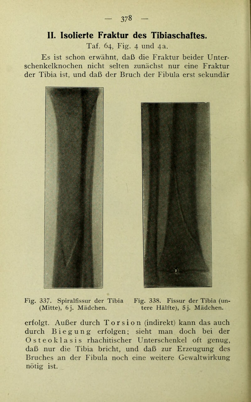 II. Isolierte Fraktur des Tibiaschaftes. Taf. 64, Fig. 4 und 4a. Es ist schon erwähnt, daß die Fraktur beider Unter- schenkelknochen nicht selten zunächst nur eine Fraktur der Tibia ist, und daß der Bruch der Fibula erst sekundär Fig. 337. Spiralfissur der Tibia Fig. 338. Fissur der Tibia (un- (Mitte), 6j. Mädchen. tere Hälfte), 5j. Mädchen. erfolgt. Außer durch Torsion (indirekt) kann das auch durch Biegung erfolgen; sieht man doch bei der Osteoklasis rhachitischer Unterschenkel oft genug, daß nur die Tibia bricht, und daß zur Erzeugung des Bruches an der Fibula noch eine weitere Gewaltwirkung nötig ist.