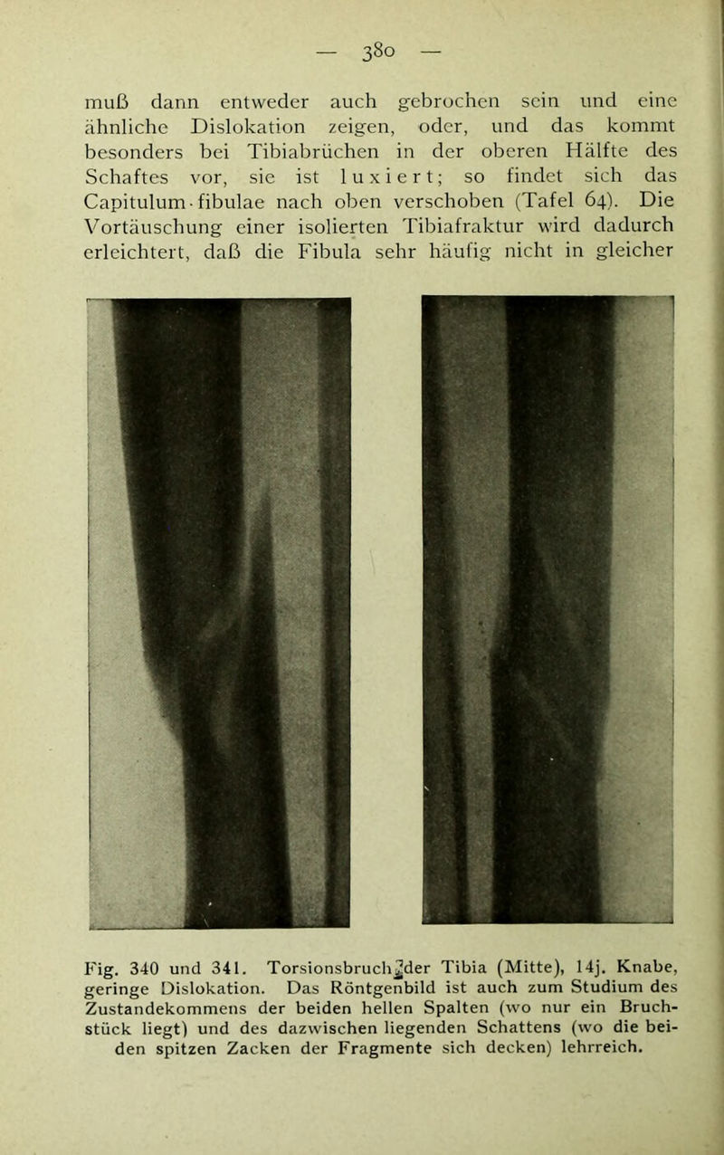 muß dann entweder auch gebrochen sein und eine ähnliche Dislokation zeigen, oder, und das kommt besonders bei Tibiabrüchen in der oberen Hälfte des Schaftes vor, sie ist 1 u x i e r t; so findet sich das Capitulum-fibulae nach oben verschoben (Tafel 64). Die Vortäuschung einer isolierten Tibiafraktur wird dadurch erleichtert, daß die Fibula sehr häufig nicht in gleicher Fig. 340 und 341. Torsionsbruch^der Tibia (Mitte), 14j. Knabe, geringe Dislokation. Das Röntgenbild ist auch zum Studium des Zustandekommens der beiden hellen Spalten (wo nur ein Bruch- stück liegt) und des dazwischen liegenden Schattens (wo die bei- den spitzen Zacken der Fragmente sich decken) lehrreich.