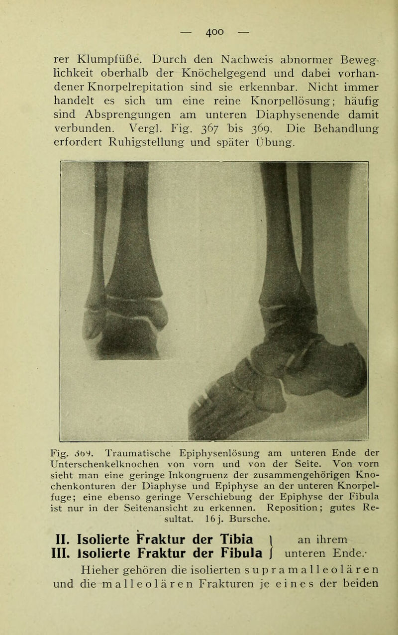 rer Klumpfüße. Durch den Nachweis abnormer Beweg- lichkeit oberhalb der Knöchelgegend und dabei vorhan- dener Knorpelrepitation sind sie erkennbar. Nicht immer handelt es sich um eine reine Knorpellösung; häufig sind Absprengungen am unteren Diaphysenende damit verbunden. Vergl. Fig. 367 bis 369. Die Behandlung erfordert Ruhigstellung und später Übung. Fig. öü-t. Traumatische Epiphysenlösung am unteren Ende der Unterschenkelknochen von vorn und von der Seite. Von vorn sieht man eine geringe Inkongruenz der zusammengehörigen Kno- chenkonturen der Diaphyse und Epiphyse an der unteren Knorpel- fuge; eine ebenso geringe Verschiebung der Epiphyse der Fibula ist nur in der Seitenansicht zu erkennen. Reposition; gutes Re- sultat. 16 j. Bursche. II. Isolierte Fraktur der Tibia \ an ihrem III. Isolierte Fraktur der Fibula j unteren Ende.- Hieher gehören die isolierten supramalleolären und die malleolären Frakturen je eines der beiden