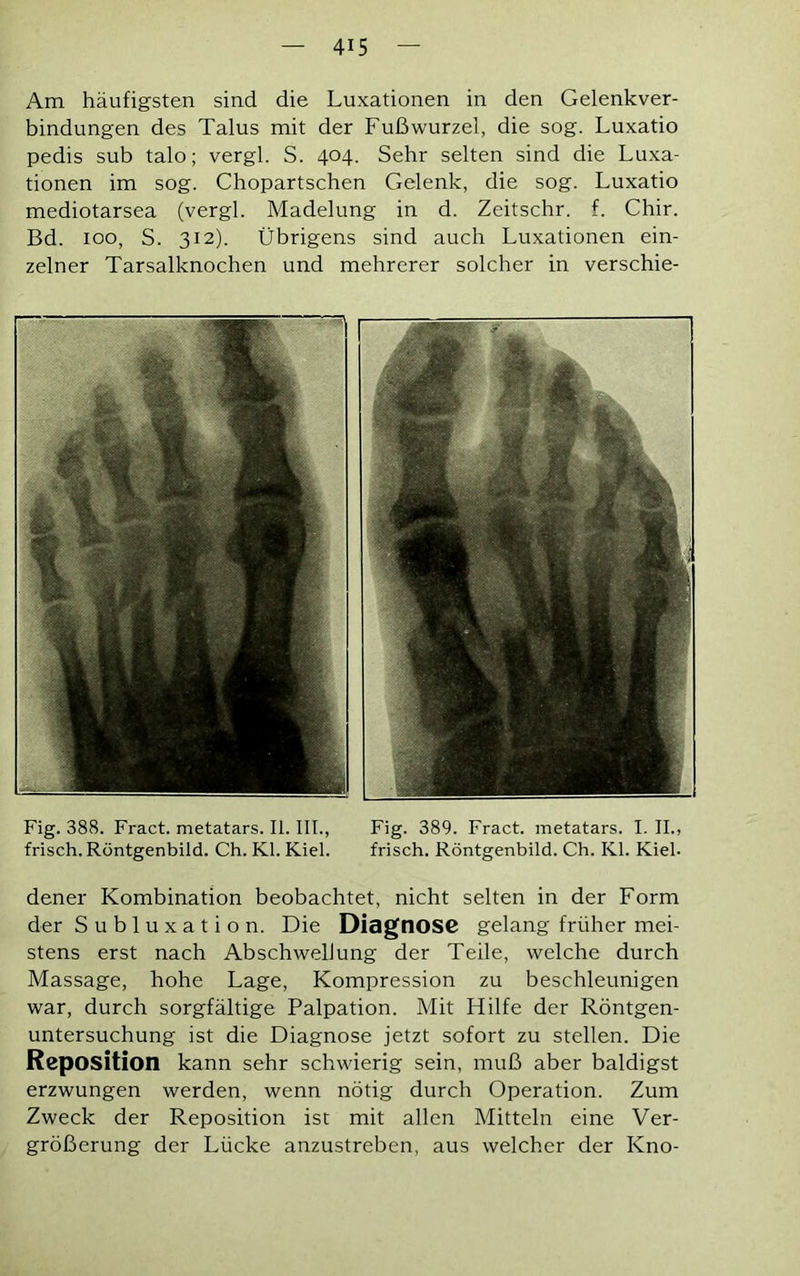 Am häufigsten sind die Luxationen in den Gelenkver- bindungen des Talus mit der Fußwurzel, die sog. Luxatio pedis sub talo; vergl. S. 404. Sehr selten sind die Luxa- tionen im sog. Chopartschen Gelenk, die sog. Luxatio mediotarsea (vergl. Madelung in d. Zeitschr. f. Chir. Bd. 100, S. 312). Übrigens sind auch Luxationen ein- zelner Tarsalknochen und mehrerer solcher in verschie- Fig. 388. Fract.metatars.Ii.III., Fig. 389. Fract. metatars. I. II., frisch. Röntgenbild. Ch. Kl. Kiel. frisch. Röntgenbild. Ch. Kl. Kiel- dener Kombination beobachtet, nicht selten in der Form der Subluxation. Die DiagtlOSC gelang früher mei- stens erst nach Abschwellung der Teile, welche durch Massage, hohe Lage, Kompression zu beschleunigen war, durch sorgfältige Palpation. Mit Hilfe der Röntgen- untersuchung ist die Diagnose jetzt sofort zu stellen. Die Reposition kann sehr schwierig sein, muß aber baldigst erzwungen werden, wenn nötig durch Operation. Zum Zweck der Reposition ist mit allen Mitteln eine Ver- größerung der Lücke anzustreben, aus welcher der Kno-