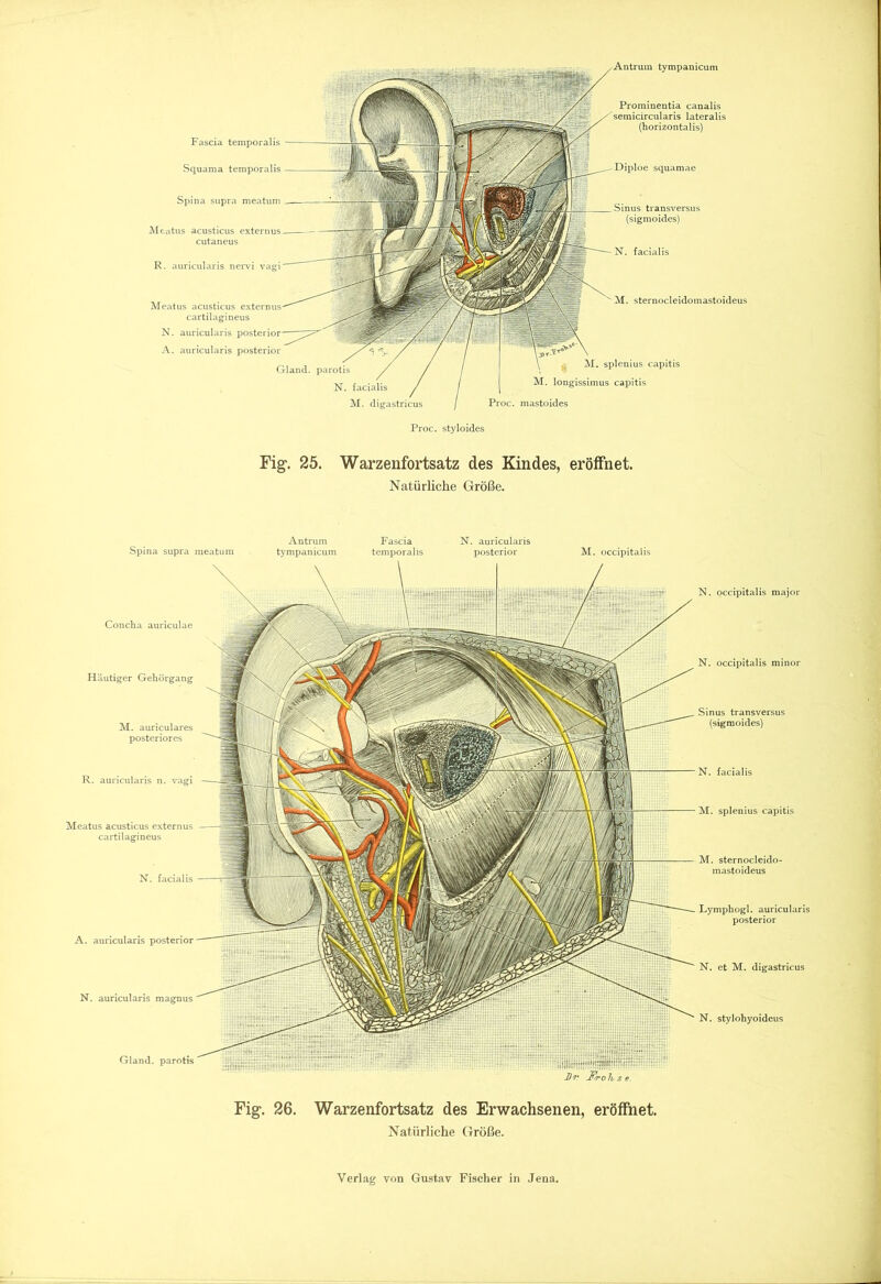 tympanicum Fascia temporalis Squama temporalis Spina supra meatum Meatus acusticus externus cutaneus R. auricularis nervi vagi Sinus transversus (sigmoides) N. facialis Meatus acusticus cartilagineus N. auricularis posterior A. auricularis posterior Gland. parotis N. facialis M. digastricus Prominentia canalis semicircularis lateralis (horizontalis) Diploe squamae M. sternocleidomastoideus M. splenius capitis M. longissimus capitis Proc. mastoides Proc. styloides Fig. 25. Warzenfortsatz des Kindes, eröffnet. Natürliche Größe. Spina supra meatum Antrum tympanicum Fascia N. auricularis temporalis posterior M. occipitalis Concha auriculae Häutiger Gehörgang M. auriculares posteriores R. auricularis n. vagi Meatus acusticus externus cartilagineus N. facialis A. auricularis posterior N. auricularis magnus Gland. parotis N. occipitalis major N. occipitalis minor Sinus transversus (sigmoides) N. facialis M. splenius capitis M. sternocleido- mastoideus Lymphogl. auricularis posterior N. et M. digastricus N. stylohyoideus Fig. 26. Warzenfortsatz des Erwachsenen, eröffnet. Natürliche Größe.