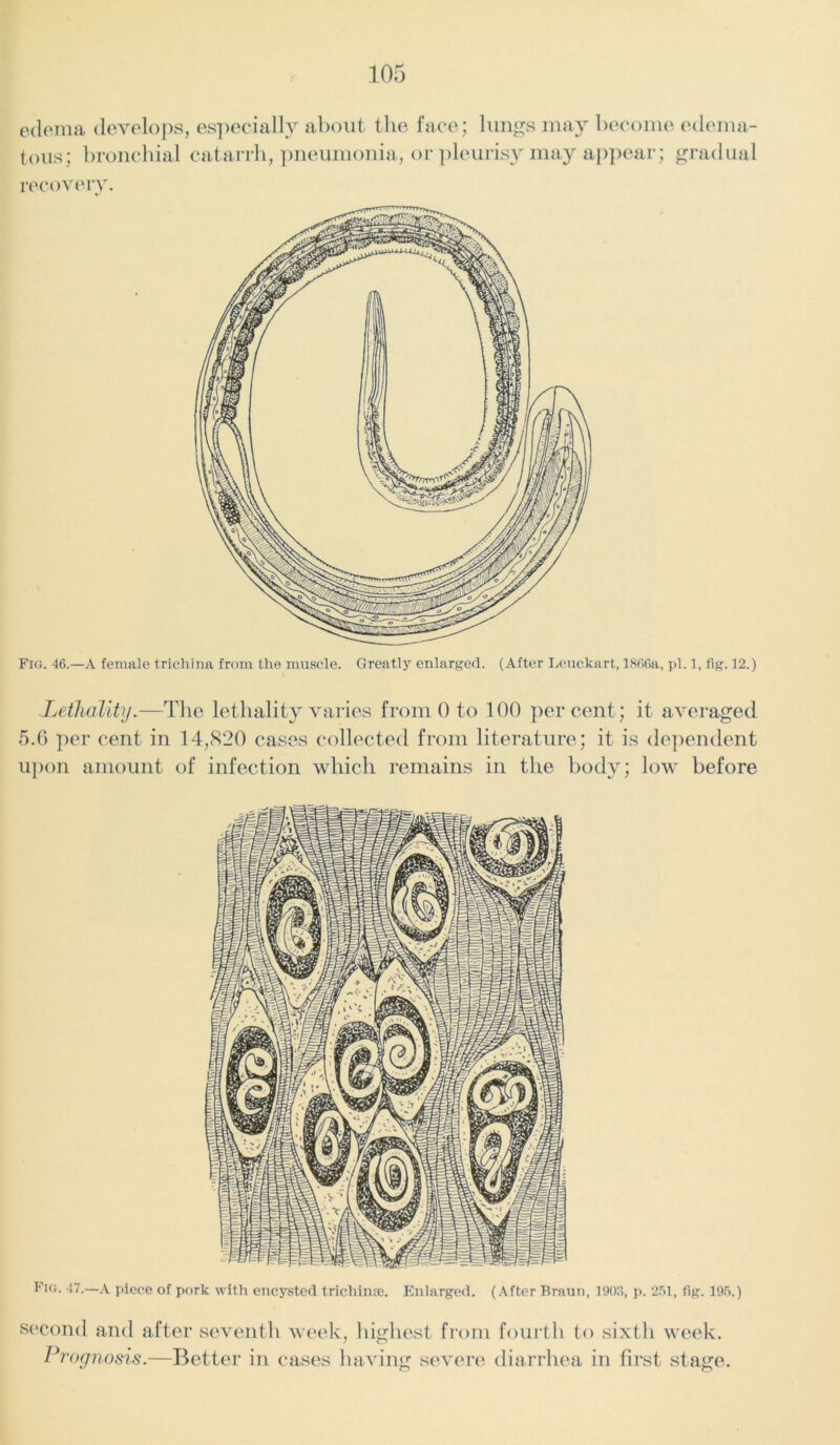 edema develops, especially about the face; lungs may become edema- tous; bronchial catarrh, pneumonia, or pleurisy may appear; gradual recovery. Fig. 46.—A female trichina from the muscle. Greatly enlarged. (After Leuckart, 1866a, pi. 1, fig. 12.) Lethality.—The lethality varies from 0 to 100 percent; it averaged 5.6 per cent in 14,820 cases collected from literature; it is dependent upon amount of infection which remains in the body; low before Fig. 47.—A piece of pork with encysted trichinae. Enlarged. (After Braun, 1903, p. 251, fig. 195.) second and after seventh week, highest from fourth to sixth week. Prognosis.—Better in cases having severe diarrhea in first stage.