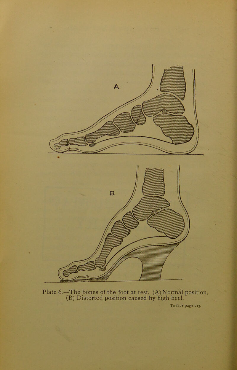 (B) Distorted position caused by high heel.
