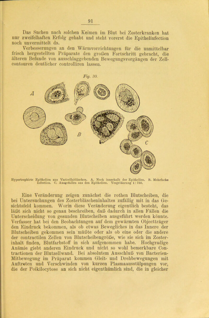 Das Suchen nach solchen Keimen im Blut bei Zosterkranken hat nur zweifelhaften Erfolg gehabt und steht vorerst die Epithelinfection noch unvermittelt da. Verbesserungen an den Wärm Vorrichtungen für die unmittelbar frisch hergestellten Präparate den großen Fortschritt gebracht, die älteren Befunde von ausschlaggebenden Bewegungsvorgängen der Zell- contouren deutlicher controlliren lassen. Fig. 30. Hypertrophirte Epithelien aus Varicellabliischen. A. Noch innerhalb der Epithelien. B. Mehrfache lnfection. C. Ausgefallen ans den Epithelien. Vergrößerung 1 : 750. Eine Veränderung zeigen zunächst die rothen Blutscheiben, die bei Untersuchungen des Zosterbläscheniuhaltes zufällig mit in das Ge- sichtsfeld kommen. Worin diese Veränderung eigentlich besteht, das läßt sich nicht so genau beschreiben, daß dadurch in allen Fällen die Unterscheidung von gesunden Blutscheiben ausgeführt werden könnte. Verfasser hat bei den Beobachtungen auf dem gewärmten Objectträger den Eindruck bekommen, als ob etwas Bewegliches in das Innere der Blutscheiben gekommen sein müßte oder als ob eine oder die andere der contractilen Zellen von Blutscheibengröße, wie sie sich im Zoster- inhalt finden, Blutfarbstoff’ in sich aufgenommen habe. Hochgradige Anämie giebt anderen Eindruck und nicht so wohl bemerkbare Con- tractionen der Blutzellwand. Bei absolutem Ausschluß von Bacterien- Mitbewegung im Präparat kommen Gleit- und Drehbewegungen mit Auftreten und Verschwinden von kurzen Plasmaausstülpuugen vor, die der Poikilocytose an sich nicht eigenthiimlich sind, die in gleicher