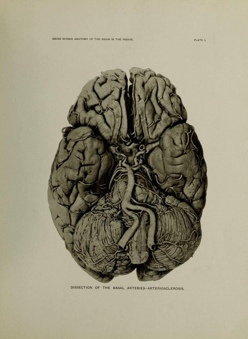 PLATE I. DISSECTION OF THE BASAL ARTERIES—ARTERIOSCLEROSIS.