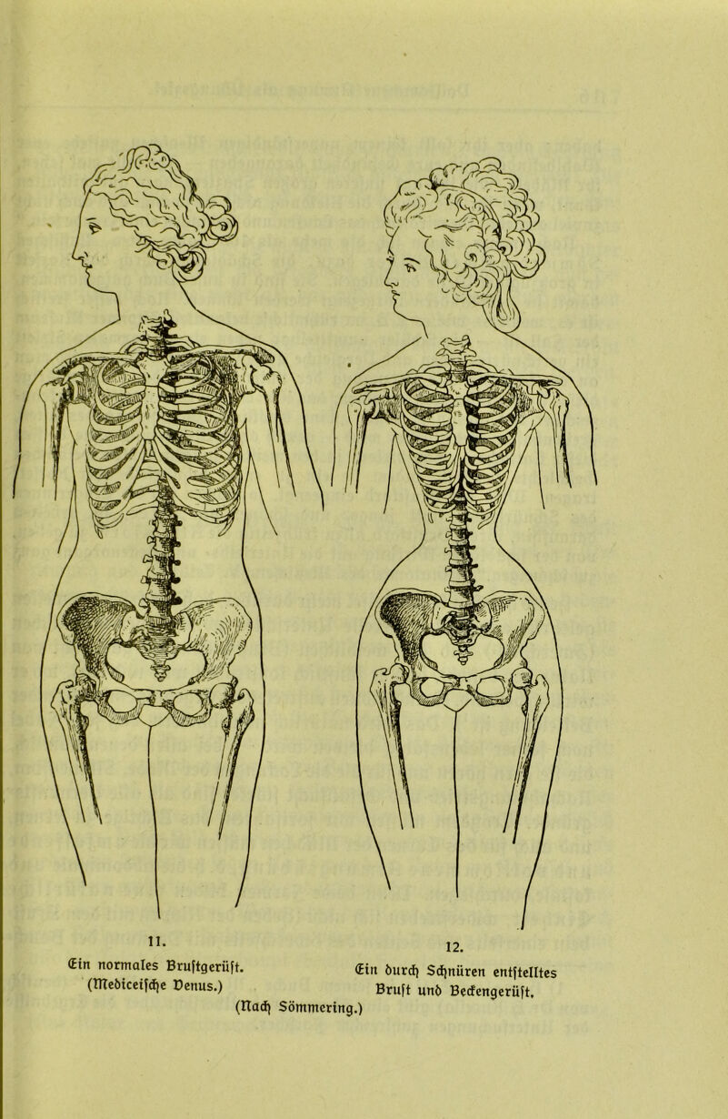 11. 12. (Ein normales Bruftgeriift. (Ein öurd} $d)nüren entftelltes (TTTeöiccifcfie üenus.) Bruft unb Becfengerüft. (Bad) Sömmcring.)