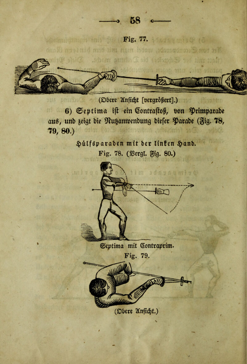 Fig. 77. (Obere tfnftcfyt [öergrofiett].) 6) ©eptima ijt ein Gonttaflof, üon ^rimparabe aus, unb geigt bie 9?u§anwenbung btefec «Patabe (gtg. 78, 79, 80.) ipülfSparaben mit bet Hafen £anb. Fig. 78. («Bergt, gtg. 80.)