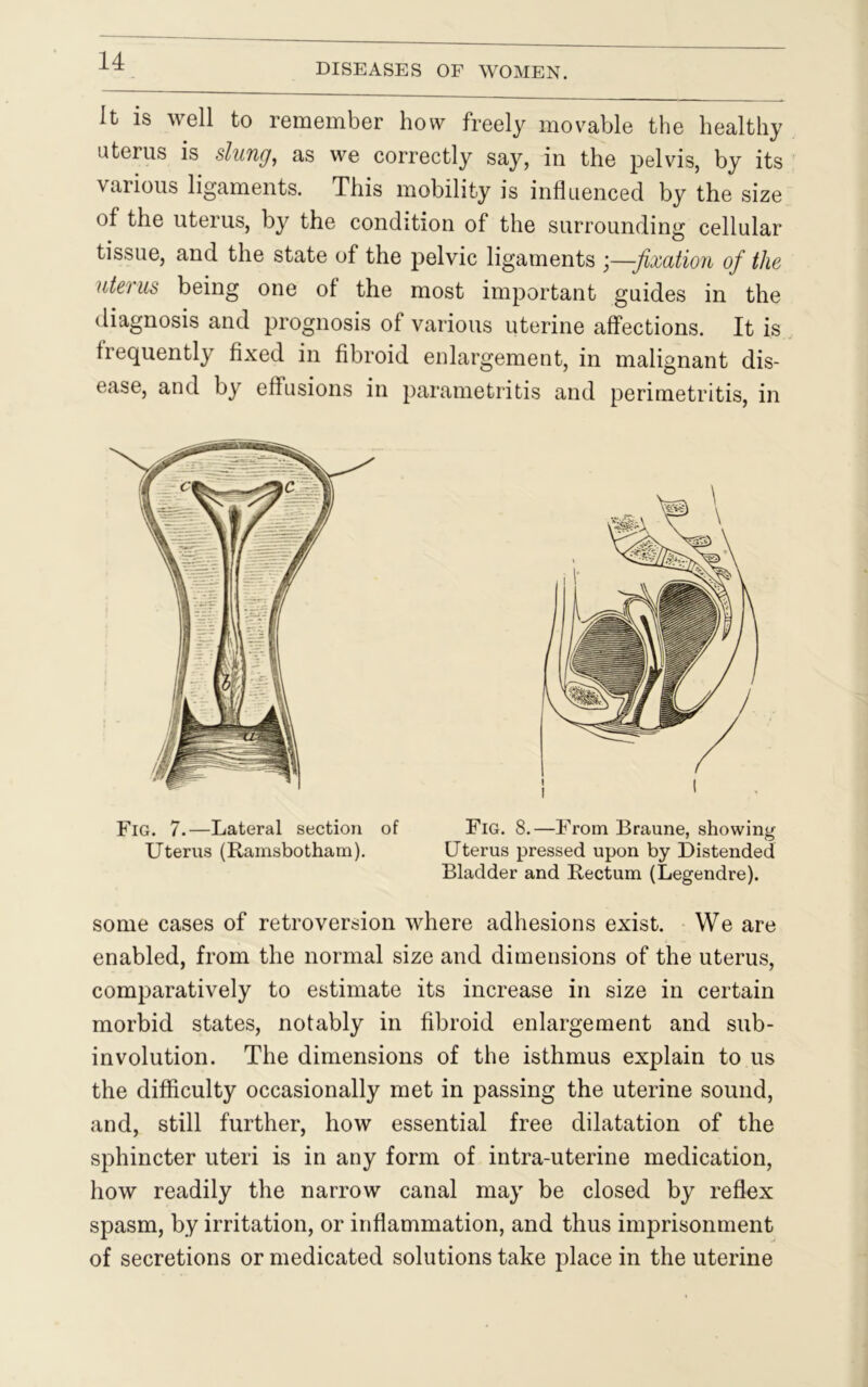 DISEASES OF WOMEN. It is well to remember how freely movable the healthy uterus is slung, as we correctly say, in the pelvis, by its various ligaments. This mobility is influenced by the size of the uterus, by the condition of the surrounding cellular tissue, and the state of the pelvic ligaments ;—fixation of the uterus being one of the most important guides in the diagnosis and prognosis of various uterine affections. It is frequently fixed in fibroid enlargement, in malignant dis- ease, and by effusions in parametritis and perimetritis, in Fig. 7.—Lateral section of Fig. 8.—From Braune, showing Uterus (Ramsbotham). Uterus pressed upon by Distended Bladder and Rectum (Legendre). some cases of retroversion where adhesions exist. We are enabled, from the normal size and dimensions of the uterus, comparatively to estimate its increase in size in certain morbid states, notably in fibroid enlargement and sub- involution. The dimensions of the isthmus explain to us the difficulty occasionally met in passing the uterine sound, and, still further, how essential free dilatation of the sphincter uteri is in any form of intra-uterine medication, how readily the narrow canal may be closed by reflex spasm, by irritation, or inflammation, and thus imprisonment of secretions or medicated solutions take place in the uterine