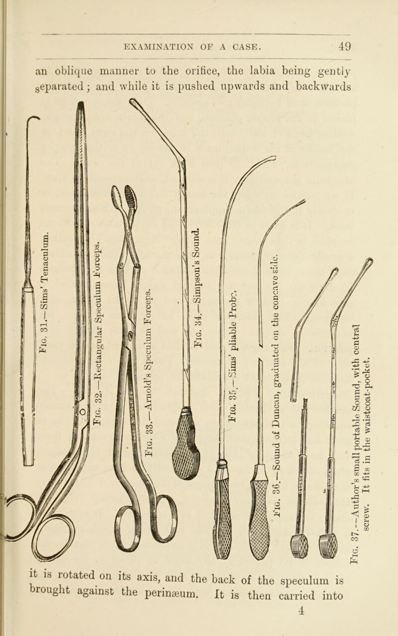 an oblique manner to the orifice, the labia being gently separated; and while it is pushed upwards and backwards it is 1 otated on its axis, and the back of the speculum is wrought against the perinseum. It is then carried into 4 Fig. 37.—Author’s small portable Sound, with central screw. It fits in the waistcoat-pocket.