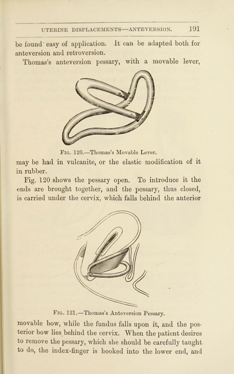 be found easy of application. It can be adapted both for anteversion and retroversion. Thomas’s anteversion pessary, with a movable lever, Fig. 120.—Thomas’s Movable Lever, may be had in vulcanite, or the elastic modification of it in rubber. Fig. 120 shows the pessary open. To introduce it the ends are brought together, and the pessary, thus closed, is carried under the cervix, which falls behind the anterior Fig. 121,—Thomas’s Anteversion Pessary. movable bow, while the fundus falls upon it, and the pos- terior bow lies behind the cervix. When the patient desires to remove the pessary, which she should be carefully taught to do, the index-finger is hooked into the lower end, and