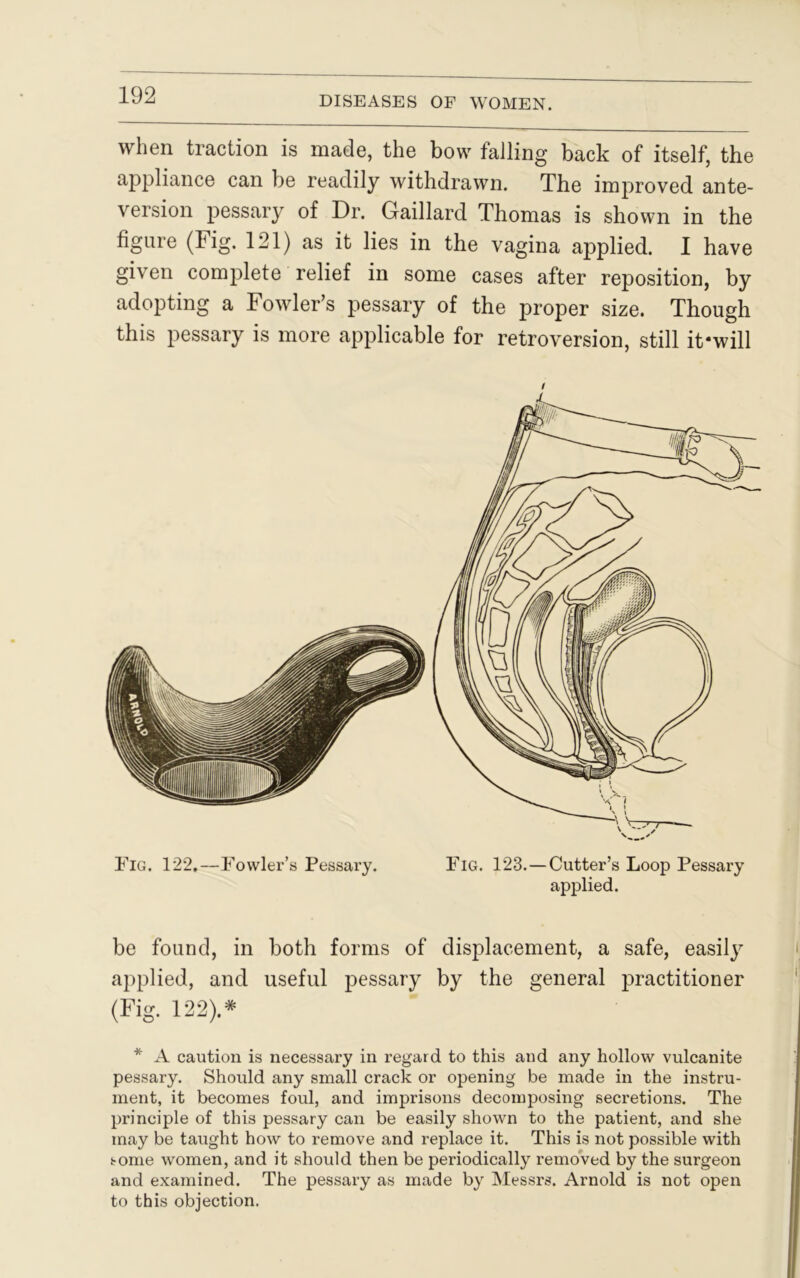 when traction is made, the bow falling back of itself, the appliance can lie readily withdrawn. The improved ante- version pessary of Dr. Gaillard Thomas is shown in the figure (Fig. 121) as it lies in the vagina applied. I have given complete relief in some cases after reposition, by adopting a Fowler’s pessary of the proper size. Though this pessary is more applicable for retroversion, still it-will Fig. 122.—Fowler’s Pessary. Fig. 123.—Cutter’s Loop Pessary applied. be found, in both forms of displacement, a safe, easily applied, and useful pessary by the general practitioner (Fig. 122).# * A caution is necessary in regard to this and any hollow vulcanite pessary. Should any small crack or opening be made in the instru- ment, it becomes foul, and imprisons decomposing secretions. The principle of this pessary can be easily shown to the patient, and she may be taught how to remove and replace it. This is not possible with some women, and it should then be periodically removed by the surgeon and examined. The pessary as made by Messrs. Arnold is not open to this objection.