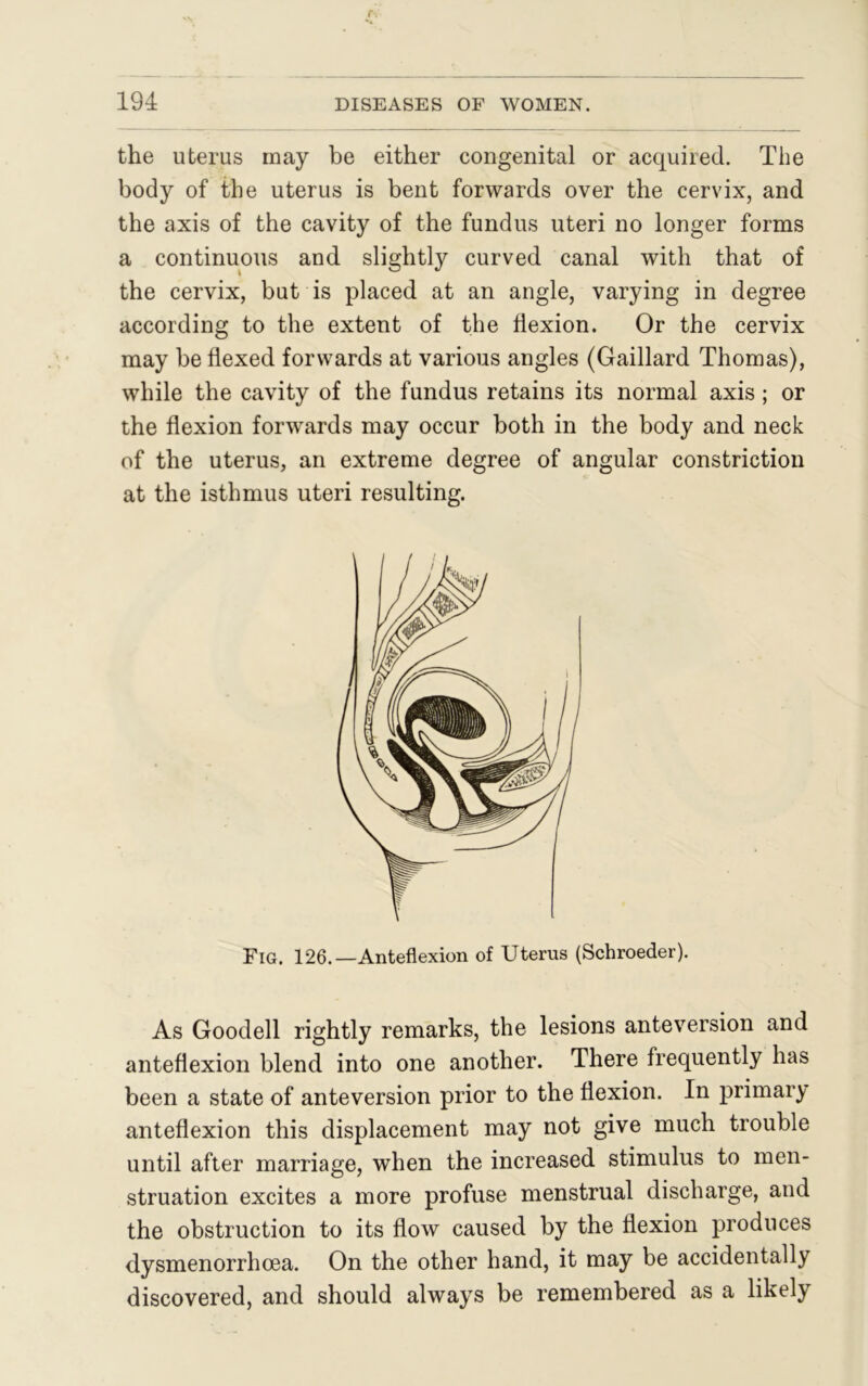 the uterus may be either congenital or acquired. The body of the uterus is bent forwards over the cervix, and the axis of the cavity of the fundus uteri no longer forms a continuous and slightly curved canal with that of the cervix, but is placed at an angle, varying in degree according to the extent of the flexion. Or the cervix may be flexed forwards at various angles (Gaillard Thomas), while the cavity of the fundus retains its normal axis; or the flexion forwards may occur both in the body and neck of the uterus, an extreme degree of angular constriction at the isthmus uteri resulting. Fig. 126.—Anteflexion of Uterus (Schroeder). As Goodell rightly remarks, the lesions anteversion and anteflexion blend into one another. There frequently has been a state of anteversion prior to the flexion. In primary anteflexion this displacement may not give much trouble until after marriage, when the increased stimulus to men- struation excites a more profuse menstrual discharge, and the obstruction to its flow caused by the flexion produces dysmenorrhoea. On the other hand, it may be accidentally discovered, and should always be remembered as a likely