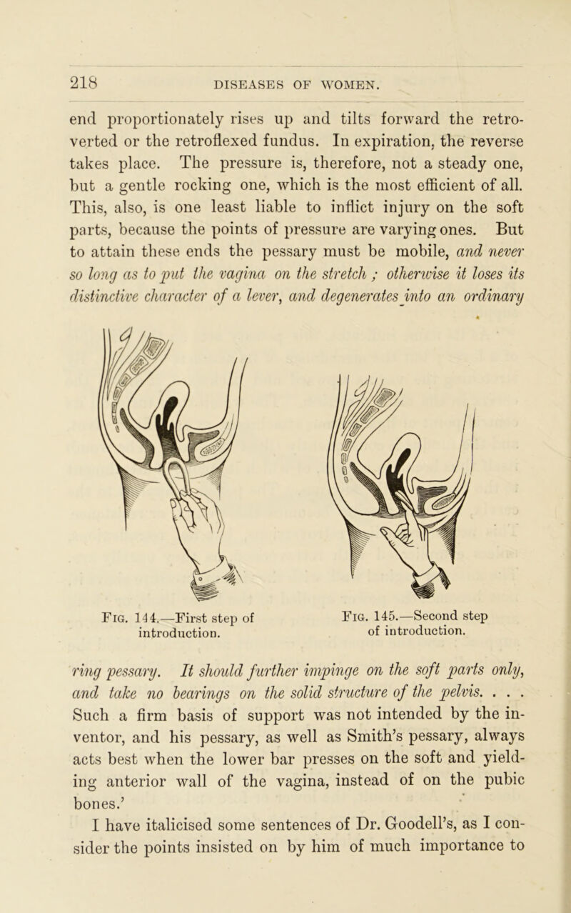 end proportionately rises up and tilts forward the retro- verted or the retroflexed fundus. In expiration, the reverse takes place. The pressure is, therefore, not a steady one, hut a gentle rocking one, which is the most efficient of all. This, also, is one least liable to inflict injury on the soft parts, because the points of pressure are varying ones. But to attain these ends the pessary must be mobile, and never so long as to put the vagina on the stretch ; otherwise it loses its distinctive character of a lever, and degenerates into an ordinary ring pessary. It should further impinge on the soft parts only, and take no hearings on the solid structure of the pelvis. . . . Such a firm basis of support was not intended by the in- ventor, and his pessary, as well as Smith’s pessary, always acts best when the lower bar presses on the soft and yield- ing anterior wall of the vagina, instead of on the pubic bones.’ I have italicised some sentences of Dr. Goodell’s, as I con- sider the points insisted on by him of much importance to Fig. 144.—First step of introduction. Fig. 145.—Second step of introduction.