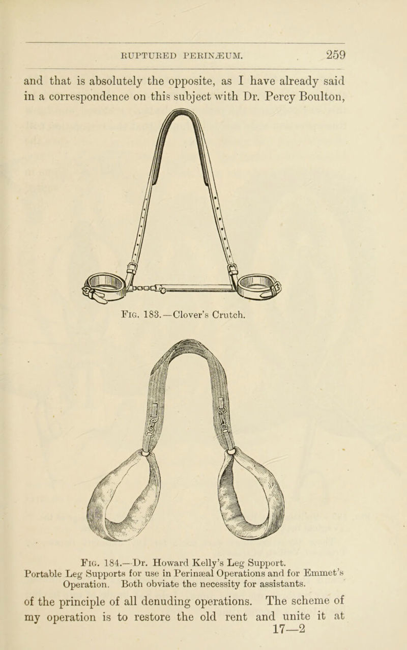 and that is absolutely the opposite, as I have already said in a correspondence on this subject with Dr. Percy Boulton, Fig. 184.—Dr. Howard Kelly’s Leg Support. Portable Leg Supports for use in Perinseal Operations and for Emmet’s Operation. Both obviate the necessity for assistants. of the principle of all denuding operations. The scheme of my operation is to restore the old rent and unite it at 17—2