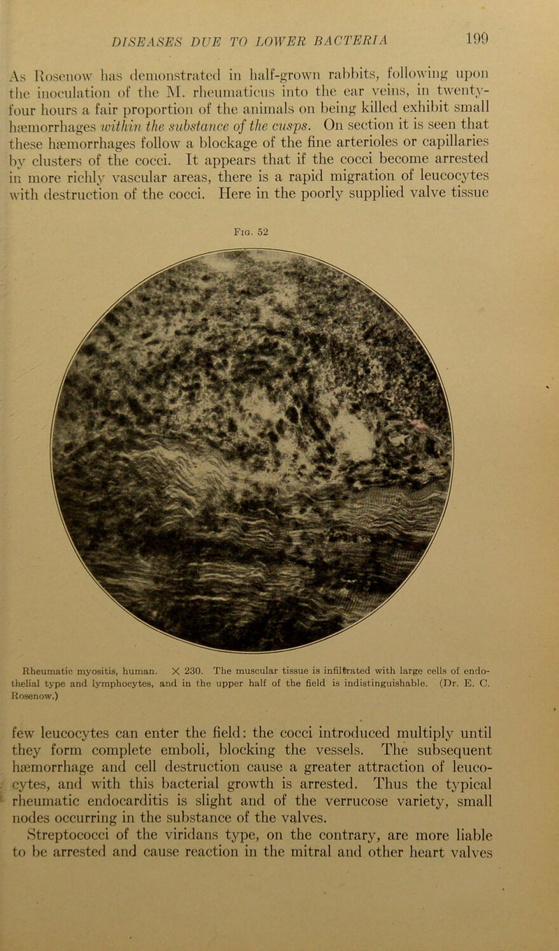 As Uoscnow has (lenionstrated in half-grown rabbits, following iijjoii the inoculation of the M. rheuinaticus into the ear veins, in twenty- four hours a fair proportion of the animals on being killed exhibit small haemorrhages within the suhstance of the cusps. On section it is seen that these haemorrhages follow a blockage of the fine arterioles or capillaries by clusters of the cocci. It appears that if the cocci become arrested in more richly vascular areas, there is a rapid migration of leucocytes with destruction of the cocci. Here in the poorly supplied valve tissue Fig. 52 Rheumatic myositis, human. X 230. The muscular tissue is infiltrated with large cells of endo- thelial type and lymphocytes, and in the upper half of the field is indistinguishable. (Dr. E. C. Rosenow.) few leucocytes can enter the field: the cocci introduced multiply until they form complete emboli, blocking the vessels. The subsequent haemorrhage and cell destruction cause a greater attraction of leuco- cytes, and with this bacterial growth is arrested. Thus the typical rheumatic endocarditis is slight and of the verrucose variety, small nodes occurring in the substance of the valves. Streptococci of the viridans type, on the contrary, are more liable to be arrested and cause reaction in the mitral and other heart valves