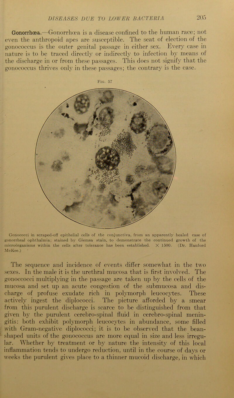 Gonorrhoea.—Gonorrhoea is a disease confined to the human race; not even the anthropoid apes are susceptible. The seat of election of the gonococcus is the outer genital passage in either sex. Every case in nature is to he traced directly or indirectly to infection by means of the discharge in or from these passages. This does not signify that the gonococcus thrives only in these passages; the contrary is the case. Fig. 57 Gonococci in scraped-off epithelial cells of the conjunctiva, from an apparently healed case of gonorrheal ophthalmia; stained by Giemsa stain, to demonstrate the continued growth of the microorganisms within the cells after tolerance has been established. X 1500. (Dr. Hanford McKee.) The sequence and incidence of events differ somewhat in the two sexes. In the male it is the urethral mucosa that is first involved. The gonoccocci multiplying in the passage are taken up by the cells of the mucosa and set up an acute congestion of the submucosa and dis- charge of profuse exudate rich in polymorph leucocytes. These actively ingest the diplococci. The picture afforded by a smear from this purulent discharge is scarce to be distinguished from that given by the purulent cerebro-spinal fluid in cerebro-spinal menin- gitis: both exhibit polymorph leucocytes in abundance, some filled with Gram-negative diplococci; it is to be observed that the bean- shaped units of the gonococcus are more equal in size and less irregu- lar. Whether by treatment or by nature the intensity of this local inflammation tends to undergo reduction, until in the course of days or weeks the purulent gives place to a thinner mucoid discharge, in which