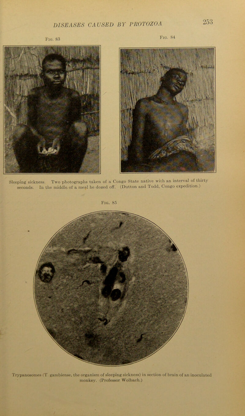 Fig. 83 Fig. 84 Sleeping sickness. Two photographs taken of a Congo State native with an interval of thirty seconds. In the middle of a meal he dozed off. (Dutton and Todd, Congo expedition.) Fig. 85 'I'rypanosomes (T. gamhiense. the organism of sleeping sickness) in section of brain of an inoculated monkey. (Professor VVolbach.)