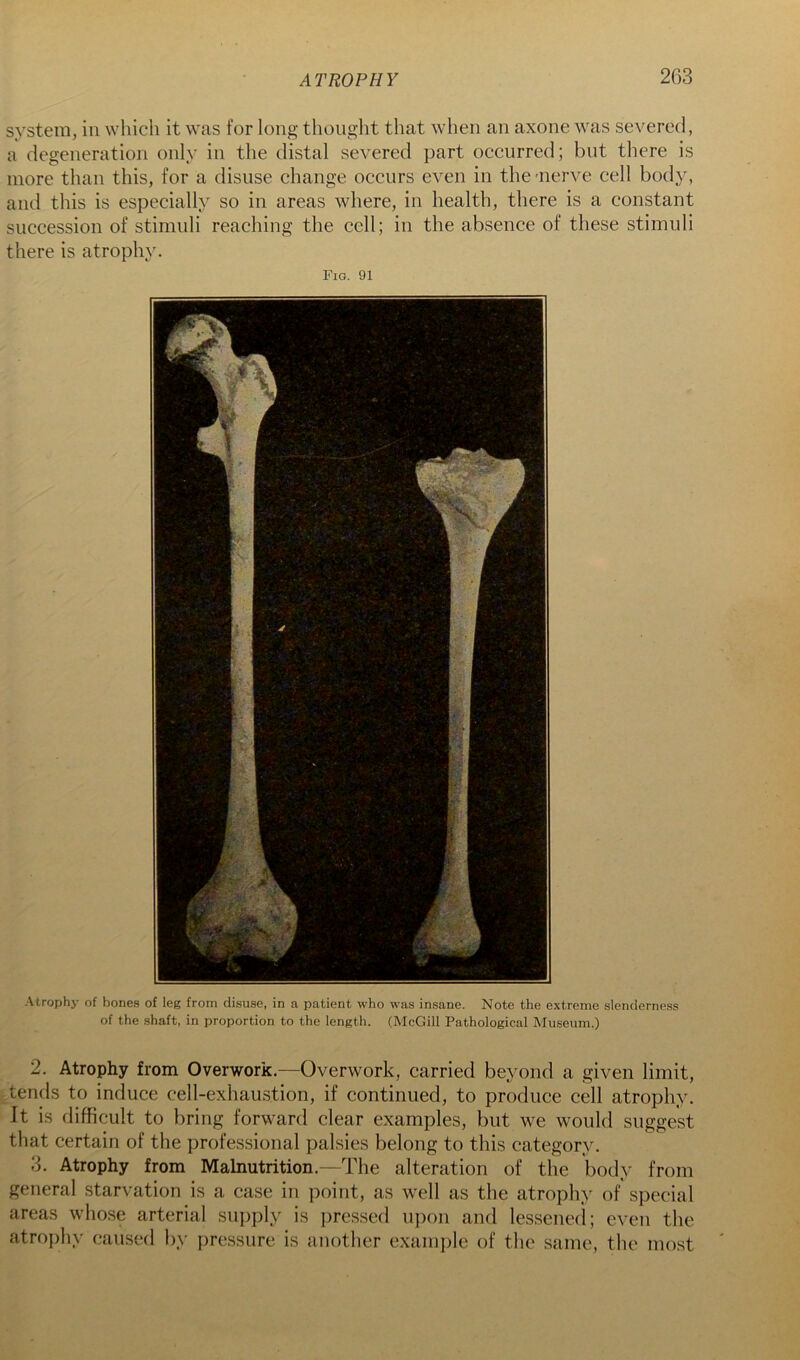 system, in which it was for long thought that when an axone was severed, a degeneration only in the distal severed part occurred; but there is more than this, for a disuse change occurs even in the -nerve cell body, and this is especially so in areas where, in health, there is a constant succession of stimuli reaching the cell; in the absence of these stimuli there is atrophy. Fig. 91 Atrophy of bones of leg from disuse, in a patient who was insane. Note the extreme slenderness of the shaft, in proportion to the length. (McGill Pathological Museum.) 2. Atrophy from Overwork.—Overwork, carried beyond a given limit, intends to induce cell-exhaustion, if continued, to produce cell atrophy. It is difficult to bring forward clear examples, but we would suggest that certain of the professional palsies belong to this category. 3. Atrophy from Malnutrition.—The alteration of the body from general starvation is a case in point, as well as the atrophy of special areas whose arterial supply is ])ressed upon and lessened; even the atrophy caused by pressure is another example of the same, the most