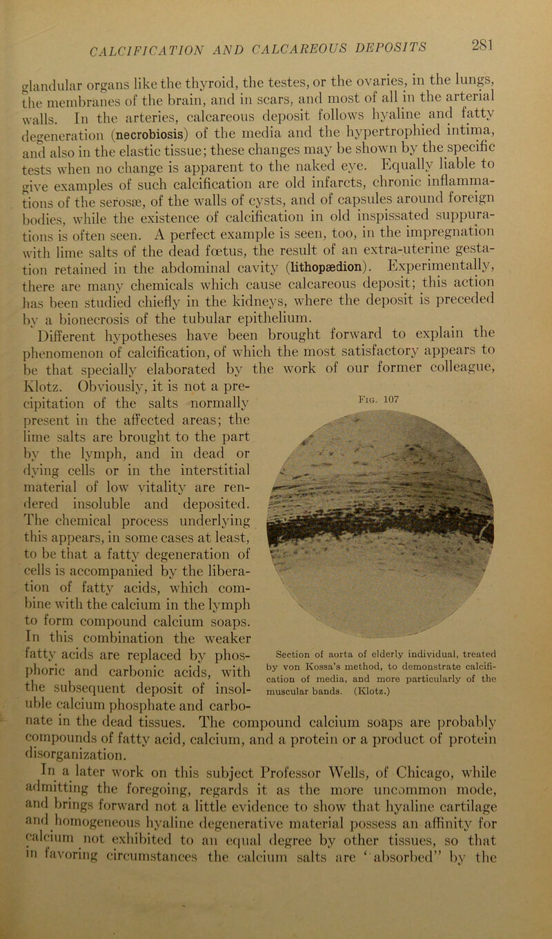 CALCIFICATION AND CALCAREOUS DEPOSITS 2S1 Fig. 107 - y glandular organs like the thyroid, the testes, or the ovaries, in the lungs, the membranes of the brain, and in scars, and most of all in the arterial walls. In the arteries, calcareous deposit follows hyaline^ and fatty degeneration (necrobiosis) of the media and the hypertrophied intirna, and also in the elastic tissue; these changes may be shown by the specific tests when no change is apparent to the naked eye. Equally liable to give examples of such calcification are old infarcts, chronic inflamma- tions of the serosae, of the walls of cysts, and of capsules around foreign bodies, while the existence of calcification in old inspissated suppura- tions is often seen. A perfect example is seen, too, in the impregnation with lime salts of the dead foetus, the result of an extra-uterine gesta- tion retained in the abdominal cavity (lithopaedion). Experirnentally, there are many chemicals which cause calcareous deposit; this action has been studied chiefly in the kidneys, where the deposit is preceded by a bionecrosis of the tubular epithelium. Different hypotheses have been brought forward to explain the phenomenon of calcification, of which the most satisfactory appears to be that specially elaborated by the work of our former colleague, Klotz. Obviously, it is not a pre- cipitation of the salts normally present in the affected areas; the lime salts are brought to the part by the lymph, and in dead or dying cells or in the interstitial material of low vitality are ren- dered insoluble and deposited. The chemical process underlying this appears, in some cases at least, to be that a fatty degeneration of cells is accompanied by the libera- tion of fatty acids, which com- bine with the calcium in the lymph to form compound calcium soaps. In this combination the weaker fatty acids are replaced by phos- phoric and carbonic acids, with the subsequent deposit of insol- uble calcium phosphate and carbo- nate in the dead tissues. The compound calcium soaps are probably compounds of fatty acid, calcium, and a protein or a product of protein disorganization. In a later work on this subject Professor Wells, of Chicago, while admitting the foregoing, regards it as the more uncommon mode, and brings forward not a little evidence to show that hyaline cartilage and homogeneous hyaline degenerative material possess an affinity for calcium not exhibited to an equal degree by other tissues, so that in favoring circumstances the calcium salts are ‘ absorbed” bv the Section of aorta of elderly individual, treated by von Kossa’s method, to demonstrate calcifi- cation of media, and more particularly of the muscular bands. (Klotz.)
