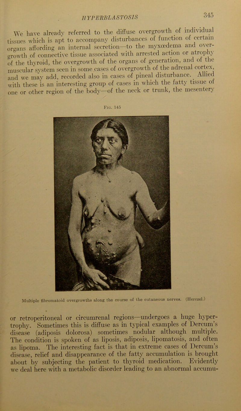 HYPERBLASTOSIS \\e have already referred to the diffuse overgrowth of individual tissues which is apt to accompany disturbances of function of certain Orleans affording an internal secretion—to the myxoedema and over- crrowth of connective tissue associated with arrested action or atrophy of the thyroid, the overgrowth of the organs of generation, and of the muscular system seen in some cases of overgrowth of the adrenal cortex, and we may add, recorded also in cases of pineal disturbance. ^ Allied with these is an interesting group of cases in which the fatty tissue of one or other region of the body—of the neck or trunk, the mesentery Fig. 145 Multiple fibromatoid overgrowths along the course of the cutaneous nerves. (Herczel.) or retroperitoneal or circumrenal regions—undergoes a huge hyper- trophy. Sometimes this is diffuse as in typical examples of Dercum’s disease (adiposis dolorosa) sometimes nodular although multiple. The condition is spoken of as liposis, adiposis, lipomatosis, and often as lipoma. The interesting fact is that in extreme cases of Dercum’s disease, relief and disappearance of the fatty accumulation is brought about by subjecting the patient to thyroid medication. Evidently we deal here with a metabolic disorder leading to an abnormal accumu-