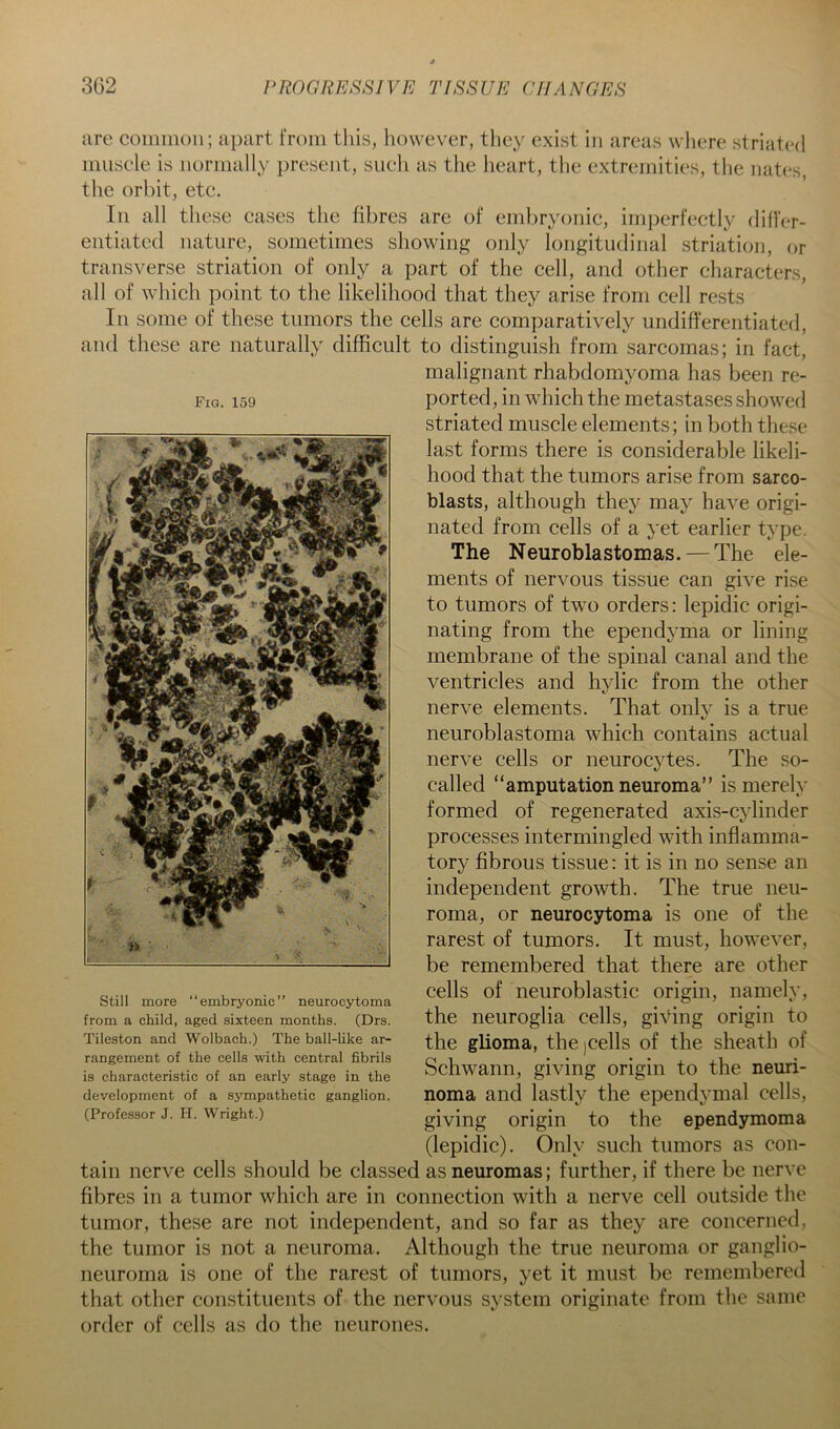 Fig. 159 are coiiiiiion; apart from tliis, however, they exist in areas where striated miisele is normally present, such as the heart, the extremities, the nates, the orbit, etc. In all these cases the fibres are of embryonic, imperfectly dilfer- entiated nature, sometimes showing only longitudinal striation, or transverse striation of only a part of the cell, and other characters, all of which point to the likelihood that they arise from cell rests In some of these tumors the cells are comparatively undifferentiated, and these are naturally difficult to distinguish from sarcomas; in fact, malignant rhabdomyoma has been re- ported, in which the metastases showed striated muscle elements; in both these last forms there is considerable likeli- hood that the tumors arise from sarco- blasts, although they may have origi- nated from cells of a yet earlier type. The Neuroblastomas. — The ele- ments of nervous tissue can give rise to tumors of two orders: lepidic origi- nating from the ependyma or lining membrane of the spinal canal and the ventricles and hylic from the other nerve elements. That only is a true neuroblastoma which contains actual nerve cells or neurocytes. The so- called “amputation neuroma” is merely formed of regenerated axis-cylinder processes intermingled with inflamma- tory fibrous tissue: it is in no sense an independent growth. The true neu- roma, or neurocytoma is one of the rarest of tumors. It must, however, be remembered that there are other cells of neuroblastic origin, namely, the neuroglia cells, giving origin to the glioma, thcjcells of the sheath of Schwann, giving origin to the neuri- noma and lastly the ependymal cells, giving origin to the ependymoma (lepidic). Only such tumors as con- tain nerve cells should be classed as neuromas; further, if there be nerve fibres in a tumor which are in connection with a nerve cell outside the tumor, these are not independent, and so far as they are concerned, the tumor is not a neuroma. Although the true neuroma or ganglio- neuroma is one of the rarest of tumors, yet it must be remembered that other constituents of the nervous system originate from the same order of cells as do the neurones. still more “embryonic” neurocytoma from a child, aged sixteen months. (Drs. Tileston and Wolbach.) The ball-like ar- rangement of the cells with central fibrils is characteristic of an early stage in the development of a sympathetic ganglion. (Professor J. H. Wright.)