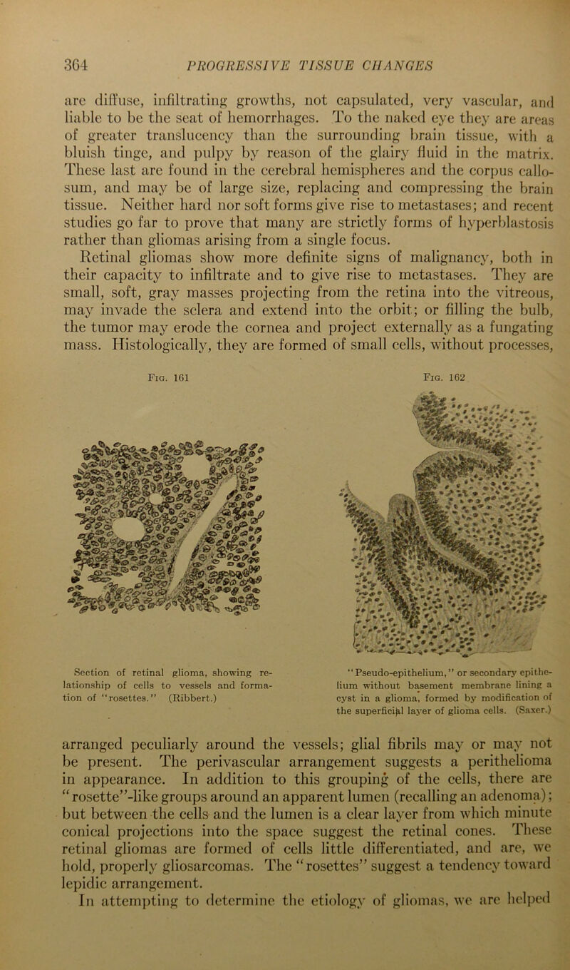 are diffuse, infiltrating growtlis, not capsulated, very vascular, and liable to be the seat of hemorrhages. To the naked eye they are areas of greater translucency than the surrounding brain tissue, with a bluish tinge, and pulpy by reason of the glairy fluid in the matrix. These last are found in the cerebral hemispheres and the corpus callo- sum, and may be of large size, replacing and compressing the brain tissue. Neither hard nor soft forms give rise to metastases; and recent studies go far to prove that many are strictly forms of hyperblastosis rather than gliomas arising from a single focus. Retinal gliomas show more definite signs of malignancy, both in their capacity to infiltrate and to give rise to metastases. They are small, soft, gray masses projecting from the retina into the vitreous, may invade the sclera and extend into the orbit; or filling the bulb, the tumor may erode the cornea and project externally as a fungating mass. Histologically, they are formed of small cells, without processes. Fig. 161 Fig. 162 Section of retinal glioma, showing re- lationship of cells to vessels and forma- tion of “rosettes.” (Ribbert.) “Pseudo-epithelium,” or secondary epithe- lium without basement membrane lining a cyst in a glioma, formed by modification of the superficial layer of glioma cells. (Saxer.) arranged peculiarly around the vessels; glial fibrils may or may not be present. The perivascular arrangement suggests a perithelioma in appearance. In addition to this grouping of the cells, there are “ rosette”-like groups around an apparent lumen (recalling an adenoma); but between the cells and the lumen is a clear layer from which minute conical projections into the space suggest the retinal cones. These retinal gliomas are formed of cells little differentiated, and are, wc hold, properly gliosarcomas. The “rosettes” suggest a tendency toward lepidic arrangement. In attempting to determine the etiology of gliomas, we are helped