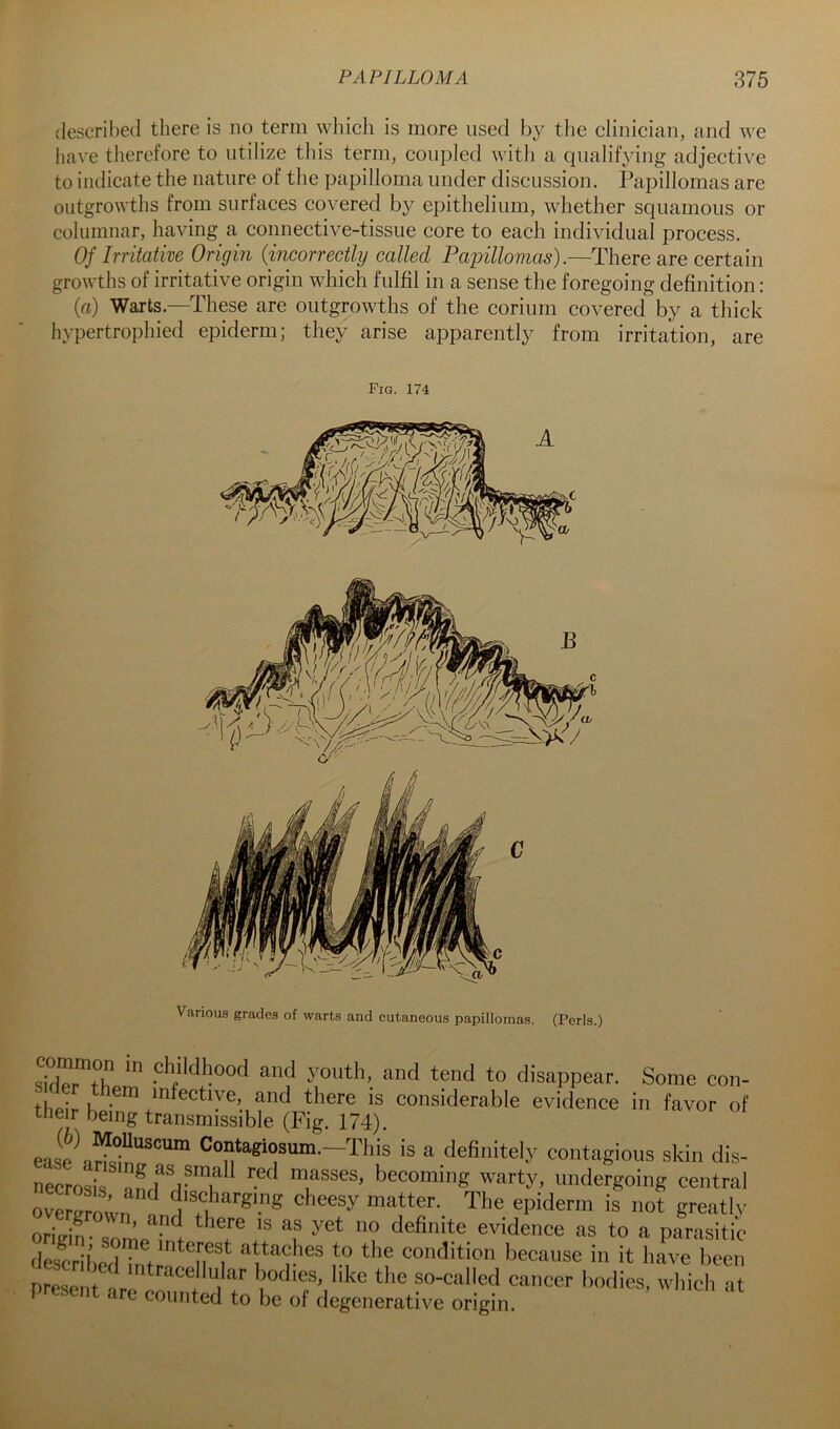 described there is no term wliicli is more used by the clinician, and we have therefore to utilize tliis term, coupled with a qualifying adjective to indicate the nature of the papilloma under discussion. Papillomas are outgrowths from surfaces covered by epithelium, whether squamous or columnar, having a connective-tissue core to each individual process. Of Irritative Origin {incorrectly called Pajnllomas).—There are certain growths of irritative origin which fulfil in a sense the foregoing definition: (a) Warts.—These are outgrowths of the corium covered by a thick hypertrophied epiderm; they arise apparently from irritation, are Fig. 174 Various grades of warts and cutaneous papillomas. (Peris.) sirlpi^+V? phi^dhood and youth, and tend to disappear. Some con- thpir K ^^^ectiye, and there is considerable evidence in favor of their being transmissible (Fig. 174). ease This is a definitely contagious skin dis- necrosis nn masses, becoming warty, undergoing central oriein- some - I evidence as to a parasitic 'leserbe,n,t n IM m '’eeause in it liave been present nrn 7 . “i  tl'e so-called cancer bodies, which at present are counted to be of degenerative origin.