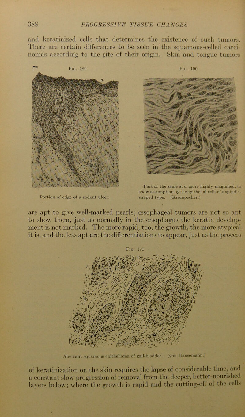 and keratinized cells that determines the existence of such tumors. There are certain dilierences to be seen in the squamous-celled carci- nomas according to the site of their origin. Skin and tongue tumors Portion of edge of a rodent ulcer. Fig. 190 Part of the same at a more highlj'^ magnified, to show assumption by the epithelial cells of a spindle- shaped type. (Krompecher.) are apt to give well-marked pearls; oesophageal tumors are not so apt to show them, just as normally in the oesophagus the keratin develop- ment is not marked. The more rapid, too, the growth, the more atypical it is, and the less apt are the dilTerentiations to appear, just as the process Fig. 191 Aberrant snuainous epithelioma of gall-bladder, (von ITansemann.) of keratinization on the skin recpiires the lajise of considerable time, and a constant slow jirogression of removal from the tleejicr, better-nourished layers below; where the growth is rapid and the cutting-ofl ot the cells