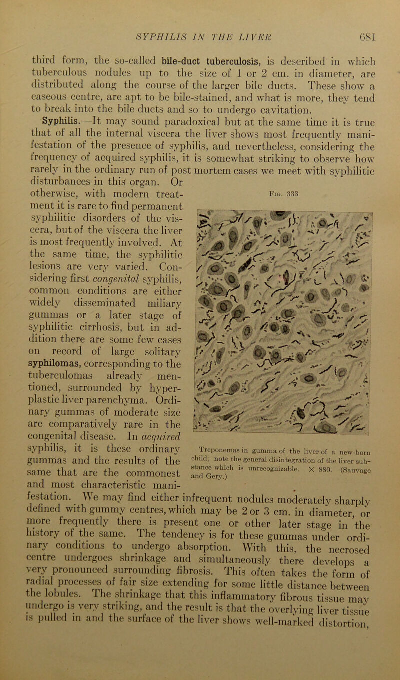 third form, the so-called bile-duct tuberculosis, is described in which tuberculous nodules up to the size of 1 or 2 cm. in diameter, are distributed along the course of the larger bile ducts. These show a caseous centre, are apt to be bile-stained, and what is more, they tend to break into the bile ducts and so to undergo cavitation. Syphilis.—It may sound paradoxical but at the same time it is true that of all the internal viscera the liver shows most frequently mani- festation of the presence of syphilis, and nevertheless, considering the frequency of acquired syphilis, it is somewhat striking to observe how rarely in the ordinary run of post mortem cases we meet with syphilitic disturbances in this organ. Or Fig. 333 :r V .V I- 'X.. • . V Vi' vr..- .4 \ A'' V I ■ O • otherwise, with modern treat- ment it is rare to find permanent syphilitic disorders of the vis- cera, but of the viscera the liver is most frequently involved. At the same time, the syphilitic lesions are very varied. Con- sidering first congenital syphilis, common conditions are either widelj'- disseminated miliary gummas or a later stage of syphilitic cirrhosis, but in ad- dition there are some few cases on record of large solitary syphilomas, corresponding to the tuberculomas already men- tioned, surrounded by hyper- plastic liver parenchyma. Ordi- nary gummas of moderate size are comparatively rare in the eongenital disease. In acquired syphilis, it is these ordinary gummas and the results of the same that are the commonest and most characteristic mani- festation. We may find either infrequent nodules moderately sharply defined with gummy centres, which may be 2 or 3 cm. in diameter, or niore frequently there is present one or other later stage in the history of the same. The tendency is for these gummas under ordi- nary conditions to undergo absorption. With this, the necrosed centre undergoes shrinkage and simultaneously there develops a very pronounced surrounding fibrosis. This often takes the form of radial processes of fair size extending for some little distance between the lobules. The shrinkage that this inflammatory fibrous tissue may undergo is very .striking, and the result is that the overlying liver tissue IS imlled in and the surface of the liver shows well-marked distortion Treponemas in gumma of the liver of a new-born child; note the general disintegration of the liver sub- stance which is unrecognizable. X 880. (Sauvage and Gery.)