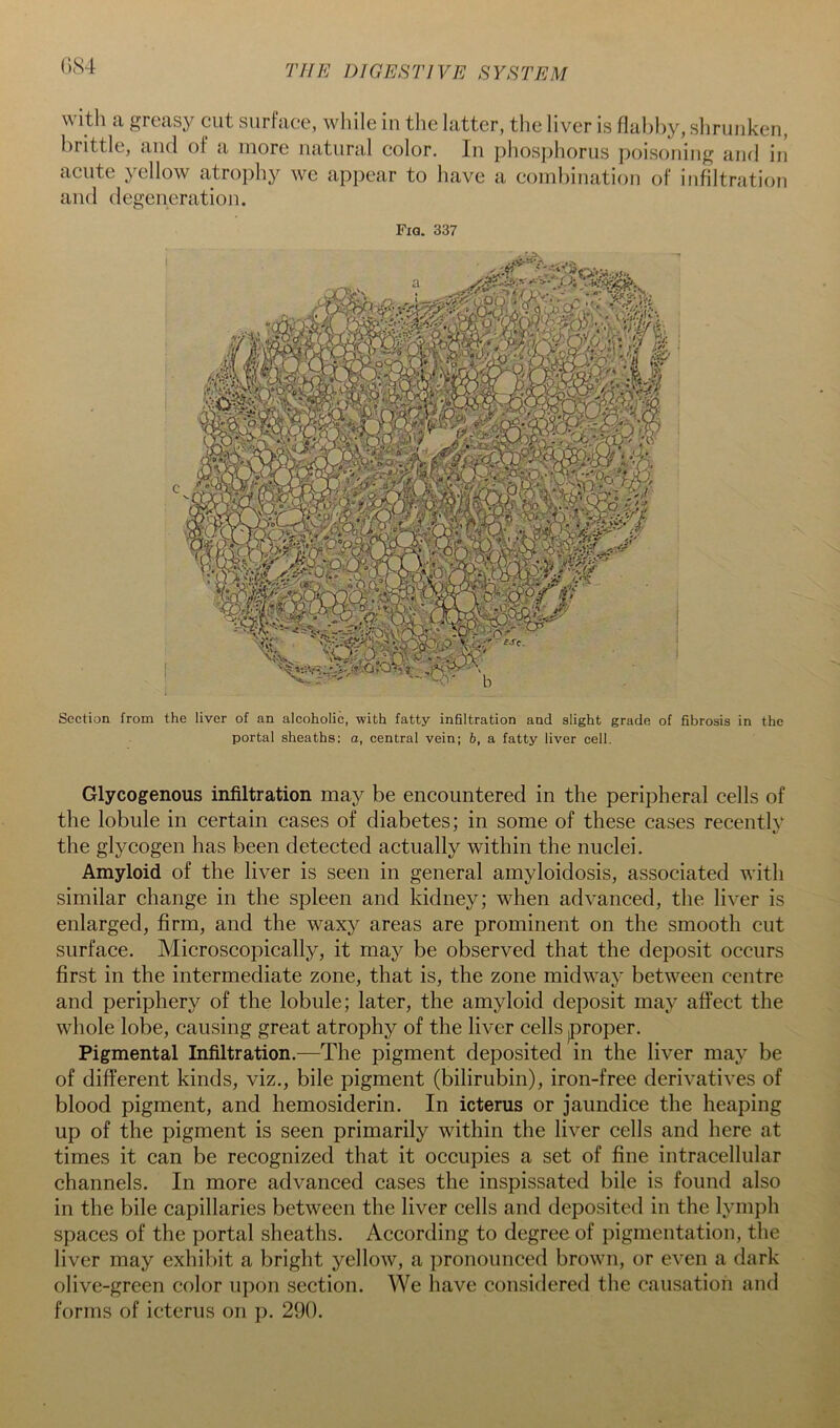 0S4 with a greasy cut surface, while iu tlie latter, the liver is flabby, shrunken, brittle, and of a more natural color. In phos])horus poisoning and in acute yellow atrophy we appear to have a combination of infiltnition and degeneration. Fig. 337 Section from the liver of an alcoholic, with fatty infiltration and slight grade of fibrosis in the portal sheaths: a, central vein; b, a fatty liver cell. Glycogenous infiltration may be encountered in the peripheral cells of the lobule in certain cases of diabetes; in some of these cases recently the glycogen has been detected actually within the nuclei. Amyloid of the liver is seen in general amyloidosis, associated with similar change in the spleen and kidney; when advanced, the liver is enlarged, firm, and the waxy areas are prominent on the smooth cut surface. Microscopically, it may be observed that the deposit occurs first in the intermediate zone, that is, the zone midway between centre and periphery of the lobule; later, the amyloid deposit may affect the whole lobe, causing great atrophy of the liver cells jproper. Pigmental Infiltration.—The pigment deposited in the liver may be of different kinds, viz., bile pigment (bilirubin), iron-free derivatives of blood pigment, and hemosiderin. In icterus or jaundice the heaping up of the pigment is seen primarily within the liver cells and here at times it can be recognized that it occupies a set of fine intracellular channels. In more advanced cases the inspissated bile is found also in the bile capillaries between the liver cells and deposited in the lymph spaces of the portal sheaths. According to degree of pigmentation, the liver may exhibit a bright yellow, a pronounced brown, or even a dark olive-green color upon section. We have considered the causation and forms of icterus on ]). 290.
