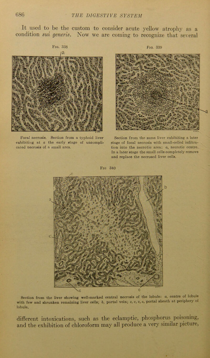 It used to be the custom to consider acute yellow atrophy as a condition sui generis. Now we are coining to recognize that several Fia. 338 Fio. 339 Focal necrosis. Section from a typhoid liver exhibiting at a the early stage of uncompli- cated necrosis of a small area. Section from the same liver exhibiting a later stage of focal necrosis with small-celled inhltra- tion into the necrotic area: o, necrotic centre. In a later stage the small cells completely remove and replace the necrosed liver cells. Section from the liver showing well-marked central necrosis of the lobule: o, centre of lobule with few and shrunken remaining liver cells; 6, portal vein; c, c, c, c, portal sheath at periphery ot lobule. Fig 340 different intoxications, such as the eclamptic, phospliorus poisoning, and the exhibition of chloroform may all produce a very similar picture,