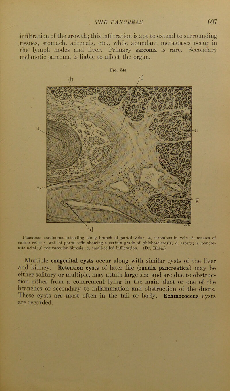 infiltration of the growth; this infiltration is apt to extend to surrounding tissues, stomach, adrenals, etc., while abundant metastases occur in the lymph nodes and liver. Primary sarcoma is rare. Secondary melanotic sarcoma is liable to affect the organ. Fig. 344 Pancreas: carcinoma extending along branch of portal vein; a, thrombus in vein; 6, masses of cancer cells; c, wall of portal veTn showing a certain grade of phlebosclerosis; d, artery; e, pancre- atic acini; /, perivascular fibrosis; g, small-celled infiltration. (Dr. Rhea.) Multiple congenital cysts occur along with similar cysts of the liver and kidney. Retention cysts of later life (ranula pancreatica) may be either solitary or multiple, may attain large size and are due to obstruc- tion either from a concrement lying in the main duct or one of the branches or secondary to inflammation and obstruction of the ducts. These cysts are most often in the tail or body. Echinococcus cysts are recorded.